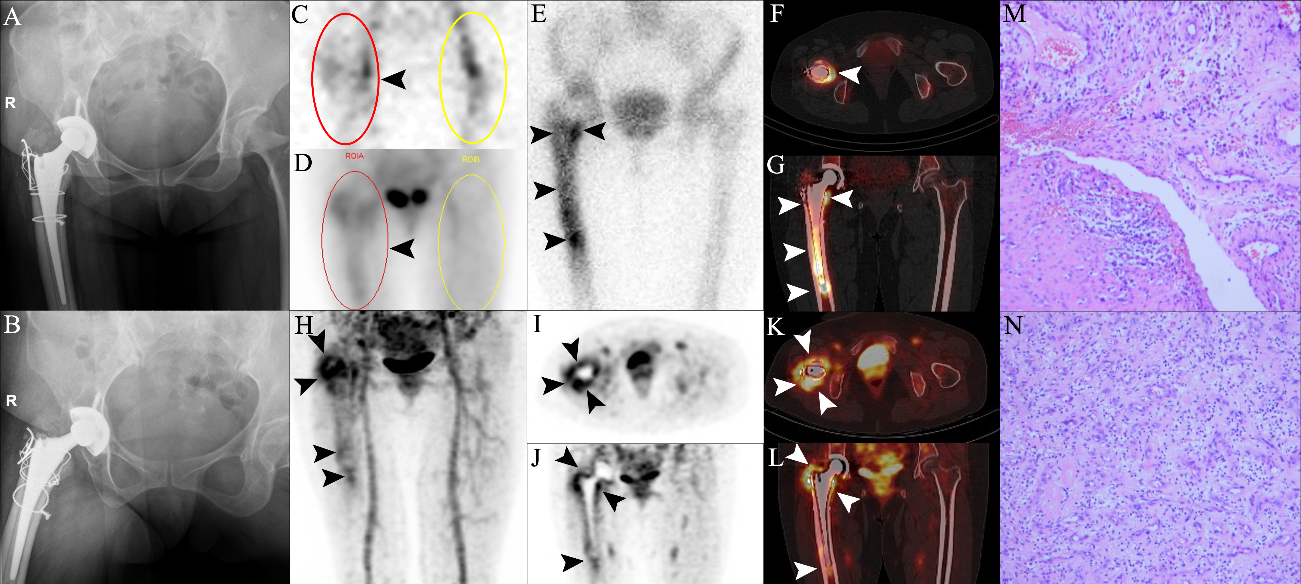 Fig. 2 
          Positive findings for infection in the three-phase bone scan, single-photon emission CT (SPECT)/CT, and positron emission tomography (PET)/CT in a patient with periprosthetic joint infection (PJI) confirmed by microbiological culture of Staphylococcus aureus and Escherichia coli. A 46-year-old woman underwent right hip arthroplasty for traumatic osteoarthritis in 2018, and developed pain in the right hip joint in April 2020. a) and b) Anteroposterior (AP) and lateral radiographs of the right hip joint at two years postoperatively showed an uneven decrease in bone density around the prosthesis. c) to e) 99mTc-MDP three-phase bone scan showed positive perfusion, blood pool, and delayed phase in the right hip (arrowheads) (red circles of c) to d) – region of interest of the affected side; yellow circles of c) to d) – region of interest of the normal side). f) and g) SPECT/CT revealed a diffuse increase in bone metabolism in the femoral prosthesis (arrowheads). h) to l) 68Ga-citrate PET/CT showed uneven diffuse uptake of the right femur trochanter around the soft-tissue and the distal femoral prosthesis (arrowheads). The patient underwent surgical treatment, and a large amount of pus was found in the right hip joint. m) and n) Histopathological examination revealed many neutrophils, lymphocytes, and plasma cells (haematoxylin and eosin (H&E) 200×). Microbial culture showed the presence of Staphylococcus aureus and Escherichia coli. PJI of the right hip was diagnosed.
        