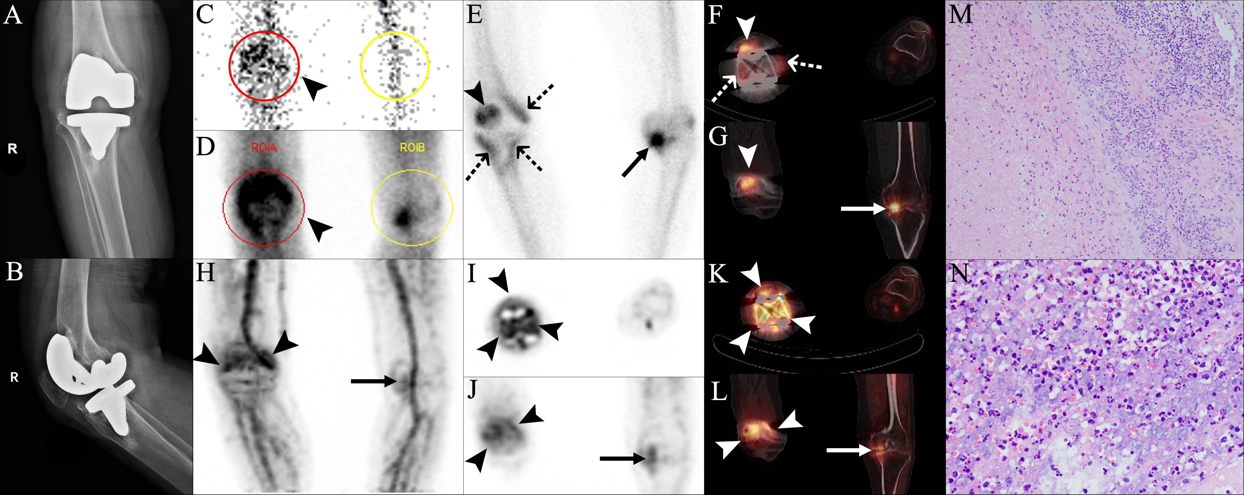 Fig. 3 
          True positive findings in three-phase bone scan and positron emission tomography (PET)/CT, and false negative findings for infection in single-photon emission CT (SPECT)/CT, in a patient with periprosthetic joint infection (PJI) caused by Staphylococcus epidermidis. A 66-year-old man underwent right knee arthroplasty for osteoarthritis (OA) in December 2019, and he developed pain and exudate in the right knee in March 2020. Further, physical examination showed swelling of the right knee joint, with a sinus tract that communicated with the prosthesis. a) and b) Anteroposterior (AP) and lateral radiographs of the right knee joint at three months postoperatively showed obvious swelling of the right knee joint and an uneven decrease in bone density around the prosthesis. The patient was diagnosed with PJI, considering the above symptoms. The patient was included in our prospective study, and he signed an informed consent form for further imaging. c) to e) 99mTc-MDP three-phase bone scan showed positive perfusion, blood pool, and delayed phase in the right knee (arrowheads) (red circle and region of interest of the affected side (ROIA); yellow circle and region of interest of the normal side (ROIB)). f) and g) SPECT/CT revealed focal increased bone metabolism at the right patella-prosthesis interface (arrowheads), and e) and f) the uniform and symmetrical uptake distributed along the edge of tibial and femoral component was regarded as non-specific uptake (dotted arrows). In addition, e) and g) show that focal uptake with hyperosteogeny was found on the medial articular surface of the left knee, which was considered to be OA (arrows). h) to l) 68Ga-citrate PET/CT showed an obvious diffuse uptake around the right knee prosthesis (arrowheads). h), j), and l) PET/CT also showed a focal uptake in the left knee joint, which was consistent with the findings of SPECT/CT (arrows). Subsequently, the patient underwent surgical treatment. m) and n) Histopathological examination showed the presence of acute suppurative inflammation (m, haematoxylin and eosin (H&E) 100×; n, H&E 400×). Staphylococcus epidermidis was found in three of the five samples.
        