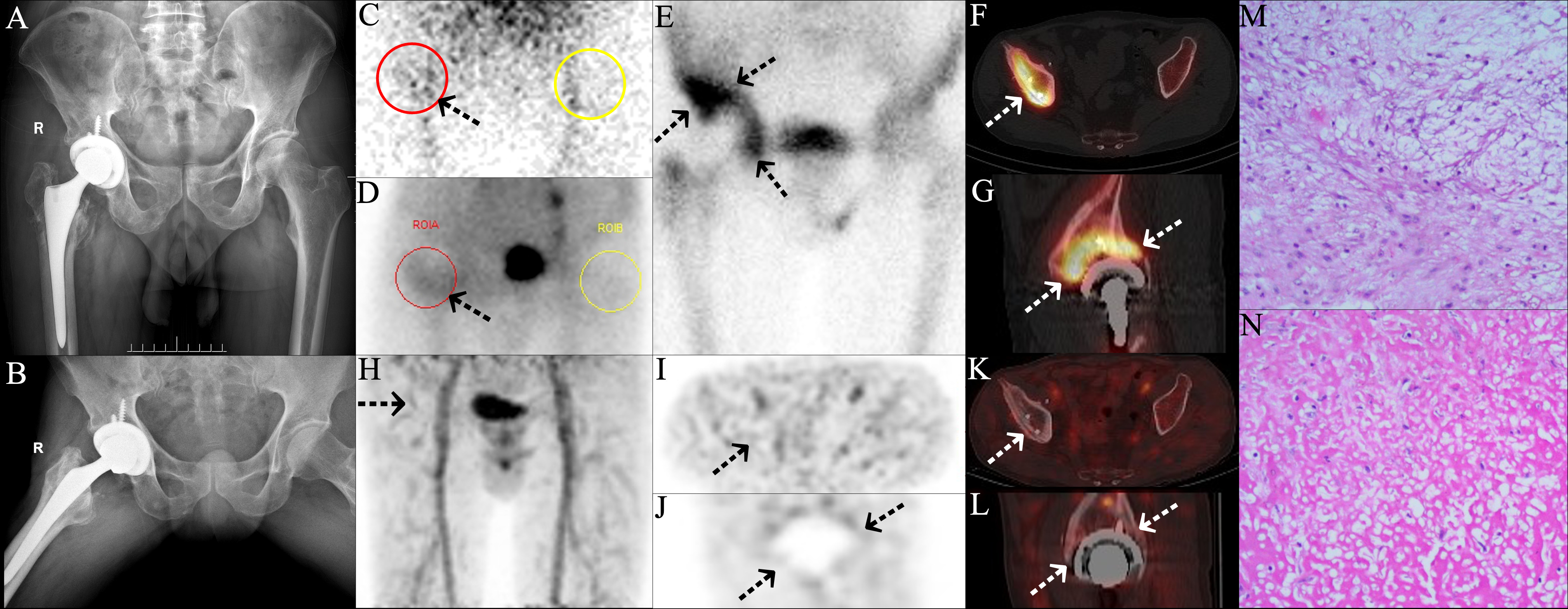 Fig. 4 
          True positive findings in the three-phase bone scan and single photon emission CT (SPECT)/CT, and false negative findings in positron emission tomography (PET)/CT, for infection in a patient with periprosthetic joint infection (PJI) confirmed by microbiological culture of Enterobacter faecalis. A 59-year-old man underwent a right hip arthroplasty for traumatic arthritis of the right hip after fracture of the right femur in 2012. Further, he underwent revision surgery for aseptic loosening (AL) of the right hip joint in 2019. He developed pain and swelling of the right hip joint one month ago. a) and b) No obvious positive signs were found in the anteroposterior (AP) and lateral radiographs postoperative at one year of the right hip joint. c) to e) 99mTc-MDP three-phase bone scan showed positive perfusion, blood pool, and delayed phase in right hip (arrows) (red circle and region of interest of the affected side (ROIA); yellow circle and region of interest of the normal side (ROIB)). f) and g) SPECT/CT revealed diffusely increased bone metabolism at the right acetabulum-prosthesis interface (arrows). h) to l) 68Ga-citrate PET/CT showed no abnormal focal or diffuse uptake (arrows). Subsequently, the patient underwent surgical treatment. m) and n) Histopathological examination of synovial tissue showed chronic inflammatory changes (haematoxylin and eosin (H&E) 400×). However, Enterobacter faecalis was found in two of the five samples. PJI of the right hip was diagnosed.
        