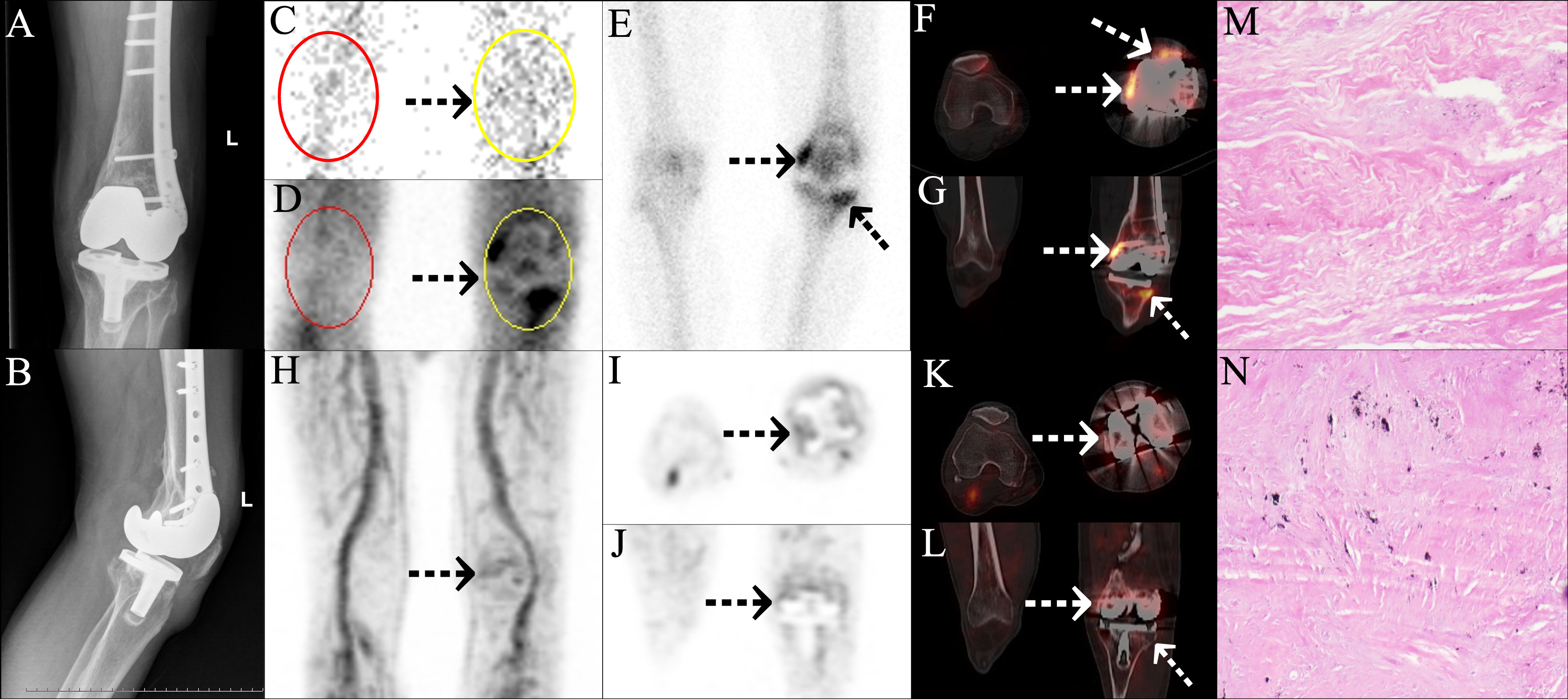 Fig. 5 
          False positive findings in three-phase bone scan and true negative findings in single-photon emission CT (SPECT)/CT and positron emission tomography (PET)/CT in a patient with aseptic loosening (AL). A 66-year-old man underwent left knee arthroplasty for traumatic osteoarthritis of the left knee after fracture of the left femur in 2009, and he developed pain in the left knee joint one week ago. a) and b) No obvious positive signs were found in the anteroposterior (AP) and lateral radiographs postoperative at ten years of the left knee joint. c) to e) 99mTc-MDP three-phase bone scan showed positive perfusion, blood pool, and delayed phase in the left knee (arrows) (red circles of c) to d) – region of interest of the affected side; yellow circles of c) to d) – region of interest of the normal side). f) and g) SPECT/CT revealed several points of focally increased bone metabolism at the bone-prosthesis interface of the left knee (arrows). h) to l) 68Ga-citrate PET/CT showed mild uptake distributed uniformly and symmetrically along the edge of the prosthesis (arrows). The patient then underwent surgical treatment, and a large amount of proliferated synovial tissue was found; the prosthetic joint was obviously loose. m) and n) Histopathological examination showed proliferative fibrous connective tissue (haematoxylin and eosin (H&E) 400×). The postoperative microbial cultures were both negative. The patient was diagnosed with AL.
        