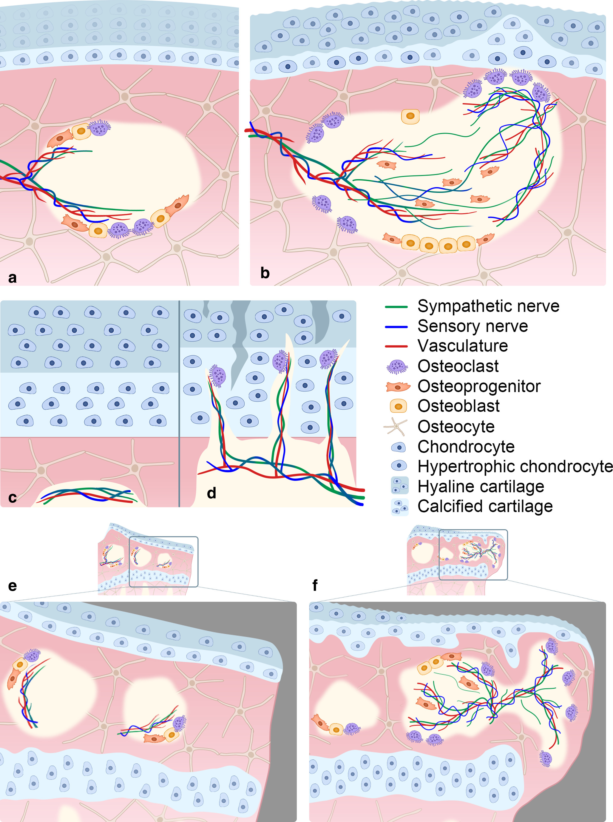 Fig. 2 
            The physiological and pathological distribution of peripheral innervation in the subchondral bone. a) and b) Schematic distribution and patterning of peripheral nerves in a) normal subchondral bone and b) osteoarthritis (OA) subchondral bone. Sensory and sympathetic nerves with vasculature present a fine branching in the subchondral bone. Both mainly locate near subchondral bone surfaces and near the bone cells, such as osteoblasts, osteoprogenitors, and osteoclasts. In OA, coupled with increased bone turnover and abnormal recruitment of osteoprogenitors, both sensory and sympathetic nerves showed aberrant and abnormal distribution, such as increased intensity and abnormal sprouting. c) and d) Peripheral innervation within osteochondral junction in c) normal and d) OA condition. Sensory nerves, sympathetic nerves, and vasculature remain in the subchondral bone without invasion into cartilage under normal conditions. In OA, the sensory and sympathetic nerves, coupled with vasculature enter calcified cartilage (CC) and even hyaline cartilage from aberrant subchondral bone through the osteochondral channels that may be induced by overactive osteoclast activity. e) and f) Peripheral innervation in e) normal subchondral bone and f) osteophytes. Sensory and sympathetic nerves with vasculature present a fine branching in the normal subchondral bone. In OA, the sensory and sympathetic nerves, accompanied by vasculature, enter into osteophytes from aberrant subchondral bone, coupled with overactive osteoclast activity.
          