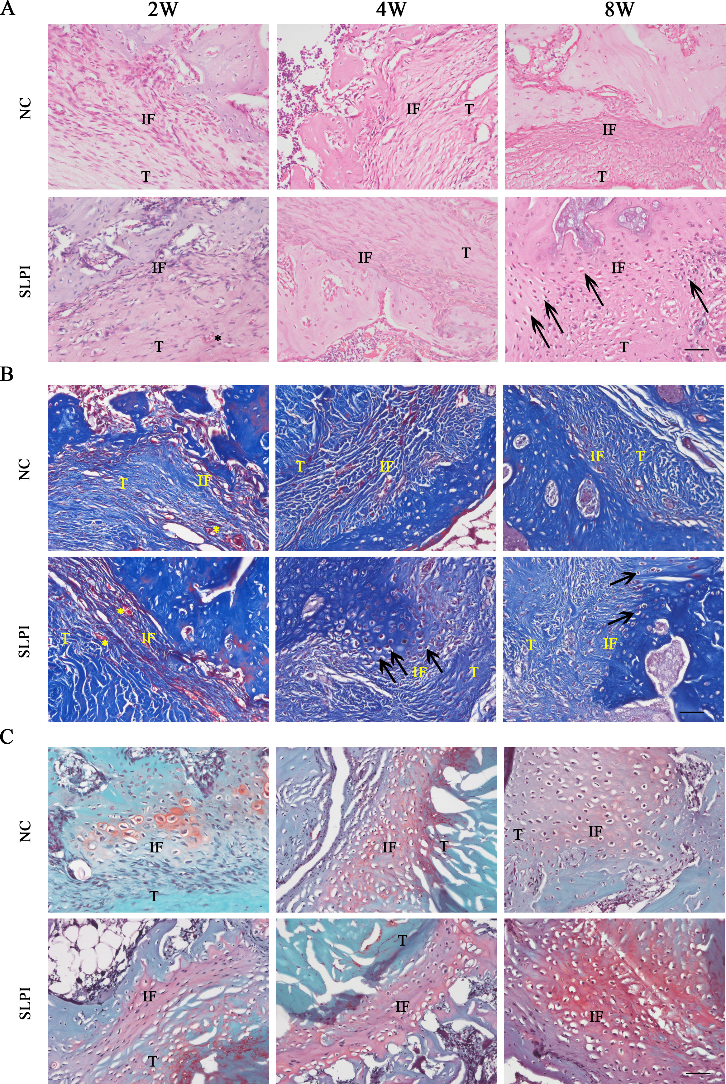 Fig. 6 
            a) Haemotoxylin and eosin (H&E) staining of the tendon-bone interface at two, four, and eight weeks after surgery in the secretory leucocyte protease inhibitor (SLPI) and negative control (NC) groups, respectively (n = 4). b) Masson’s trichrome staining of the tendon-bone interface of samples at two, four, and eight weeks in the SLPI and NC groups, respectively (n = 4). c) Modified Safranin-O/Fast Green staining of the tendon-bone interface at two, four, and eight weeks in the SLPI and NC groups, respectively (n = 4). IF, interface; T, tendon; arrow: cartilage-like cell, asterisk: neovascularization; bar 20 μm.
          