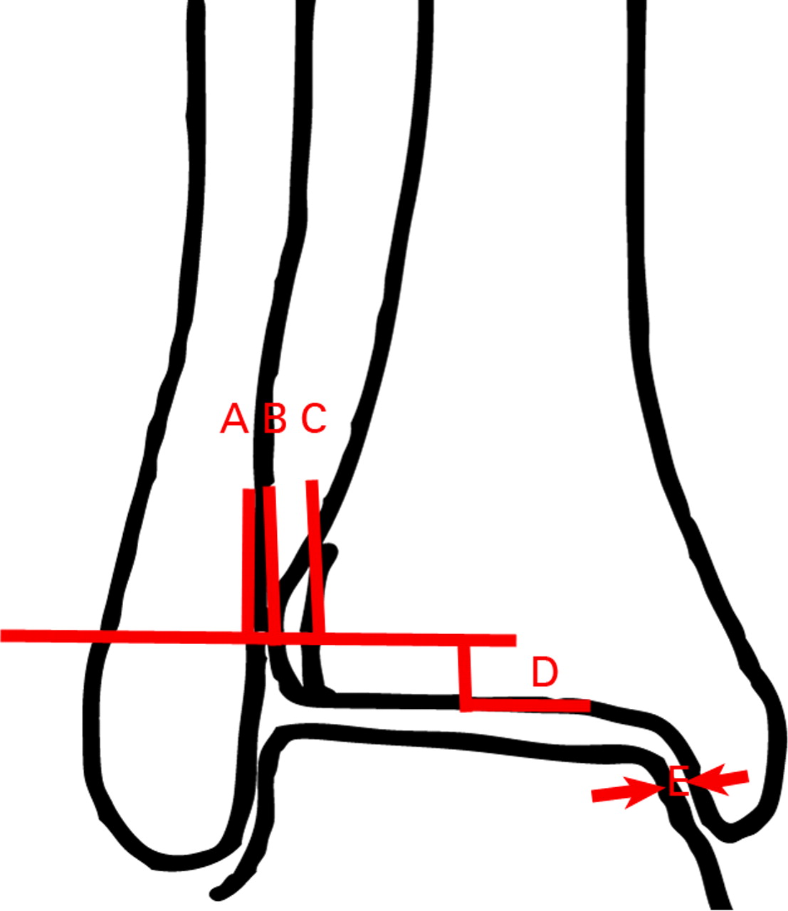 Fig. 1 
          Diagram showing the typical syndesmotic
relationship in patients without overlap between the tibia and fibula
(A, medial fibular border; B, anterior tibial tubercule; C, lateral
border of the posterior tibia; D, plane 1 cm above plafond; E, medial
clear space; AC, tibiofibular clear space). The distance AB in these
patients is positive.
        