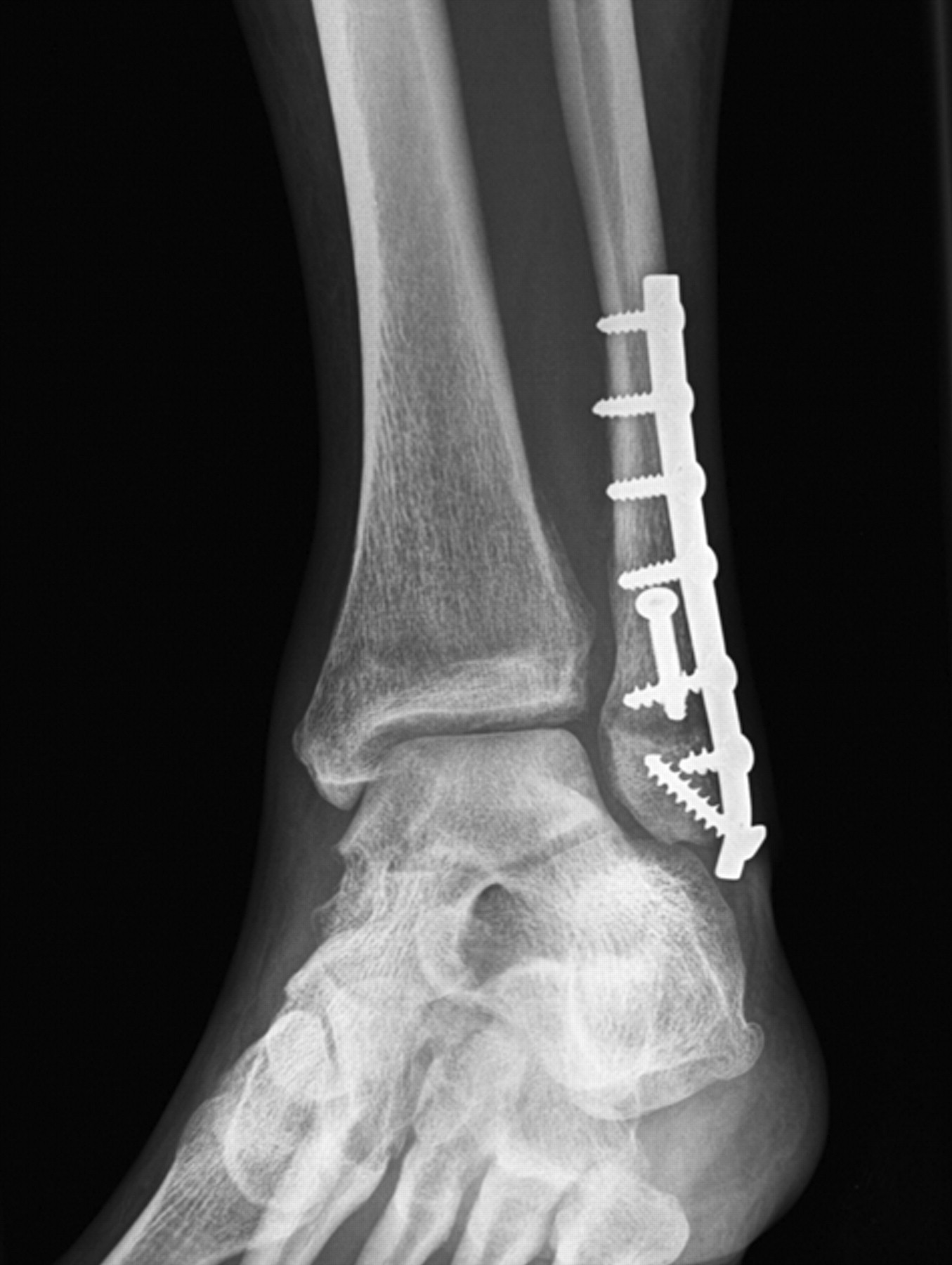 Fig. 2 
          Plain radiographs post-operatively of
a 32-year-old female patient who sustained a Weber B fracture of
the left ankle, with no overlap existing between the tibia and fibula,
showing a) the left ankle, which showed no increase in the distance
between the tibia and fibula or increase of the medial clear space
during intra-operative testing and b) the right ankle, showing that
the condition was present on the right side, which had no history
of trauma, pain or previous surgery.
        