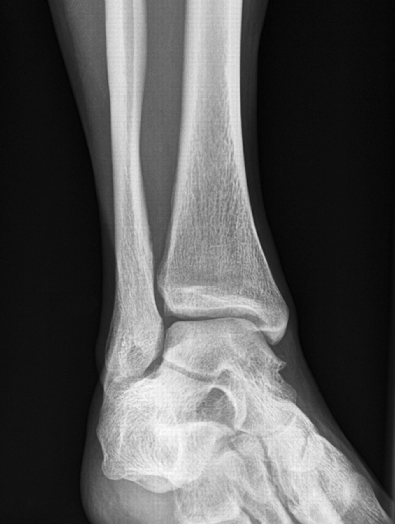 Fig. 2 
          Plain radiographs post-operatively of
a 32-year-old female patient who sustained a Weber B fracture of
the left ankle, with no overlap existing between the tibia and fibula,
showing a) the left ankle, which showed no increase in the distance
between the tibia and fibula or increase of the medial clear space
during intra-operative testing and b) the right ankle, showing that
the condition was present on the right side, which had no history
of trauma, pain or previous surgery.
        