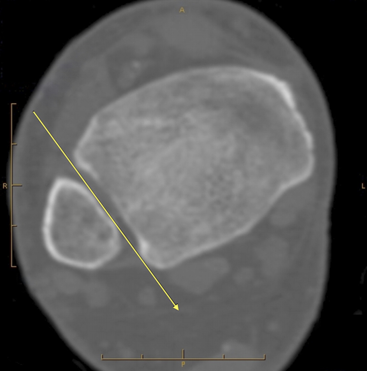 Figs. 3a - 3c 
          
            Figures 3a and 3b – axial CT
views a) in a patient with overlap between the distal tibia and
fibula, showing that a plain film x-ray beam (represented by the
yellow arrow) cannot be passed between the bones, and b) in a patient
without overlap, with the x-ray beam (yellow line) able to pass
between the tibia and fibula. Figure 3c – three-dimensional image
of the patient in Figure 3b, reconstructed from CT scans. This image
resembles a radiograph and can be rotated through 360° using GE
Workstation software (GE Healthcare).
        