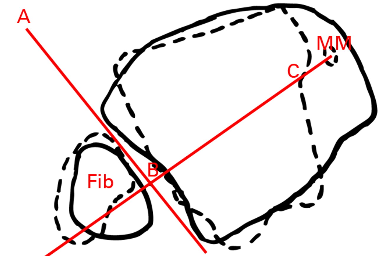 Figs. 4a - 4c 
          
            Figure 4a – diagram of a mortise
view showing approximate levels of axial slices shown in the diagrams in
Figures 4b and 4c. Line 1 is represented by solid lines and Line
2 represented by dotted lines in Figures 4b and 4c. Line 3 is the
line between the tips of the medial and lateral malleoli (intermalleoli
line). Figures 4b and 4c – diagrams of superimposed axial slices
for b) measurement of the angle (ABC) between the diastasis (AB)
and the intermalleoli axis (BC), and c) measurement of the angle
(ABC) between the diastasis (AB) and the talus (BC) (MM, medial
malleolus).
        