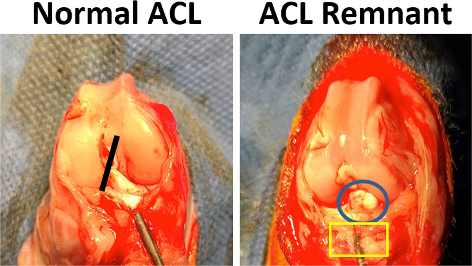 Fig. 1 
            Representative pictures of anterior cruciate ligament (ACL) remnant harvest. The ACL was detached from the femoral insertion (black line) to create the ACL complete tear model (left panel). Four weeks later, the rabbit’s ACL remnant (blue circle) and proximal tibia (yellow frame) were harvested for further ACL remnant cell (ACLRC) and bone marrow cell culture (right panel).
          