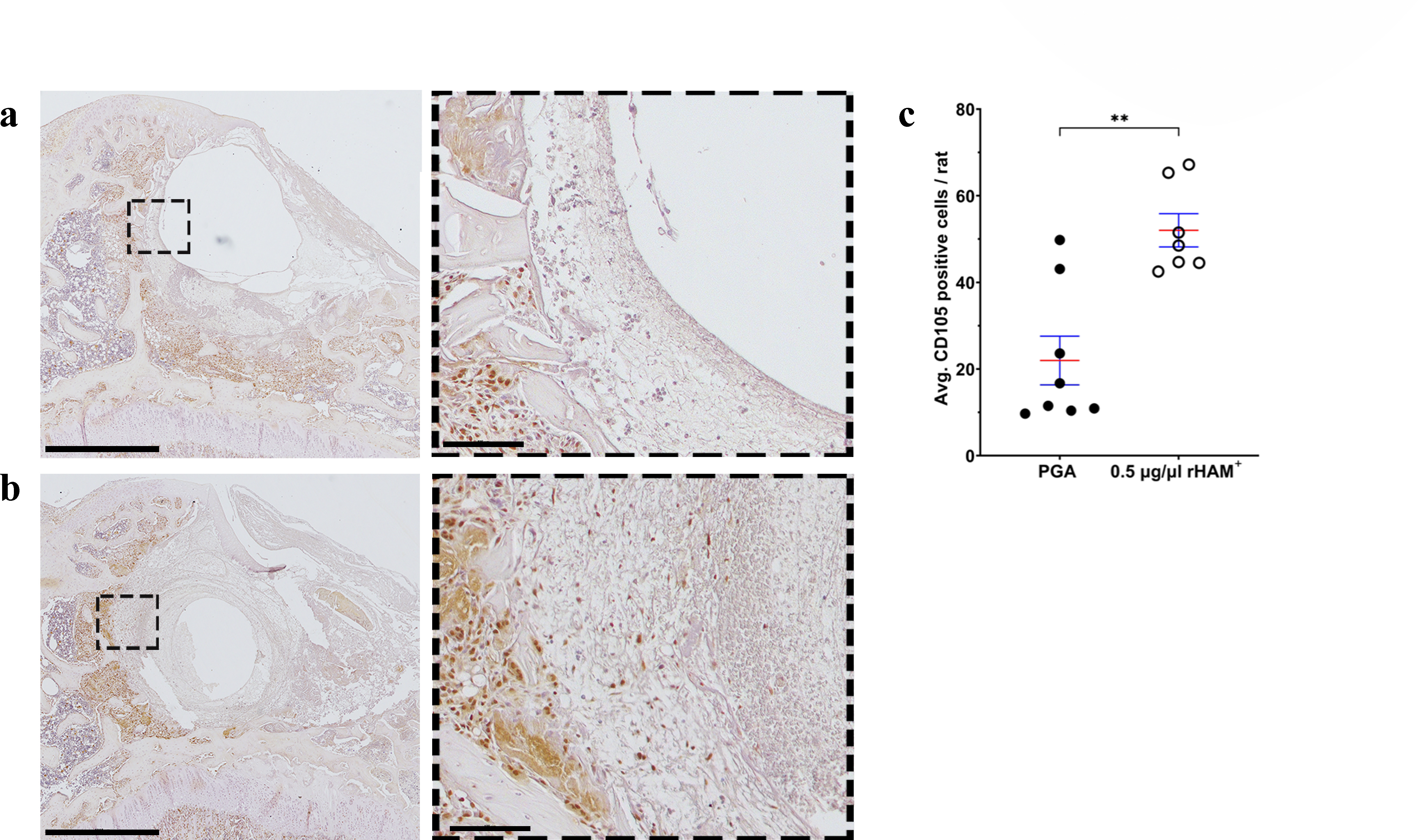 Fig. 4 
            Histological analysis of the granulation tissue at the osteochondral injury (OCI) four days after treatment. Immunohistochemistry for CD105 expression after treatment with a) propylene glycol alginate (PGA) alone (n = 8) and b) 0.5 μg/μl recombinant human amelogenin protein (rHAM+) (n = 7). Scale bar: 1,000 μm. Enlarged pictures (×20) were taken from the regions marked with black frames, scale bar: 100 μm. Brown staining: CD105 positive cells; purple staining (haematoxylin and eosin (H&E)): CD105 negative cells. c) Average number of cells in the granulation tissue and surrounding of the OCI. Data presented as mean (standard error of the mean). **p < 0.01, Mann-Whitney U test.
          