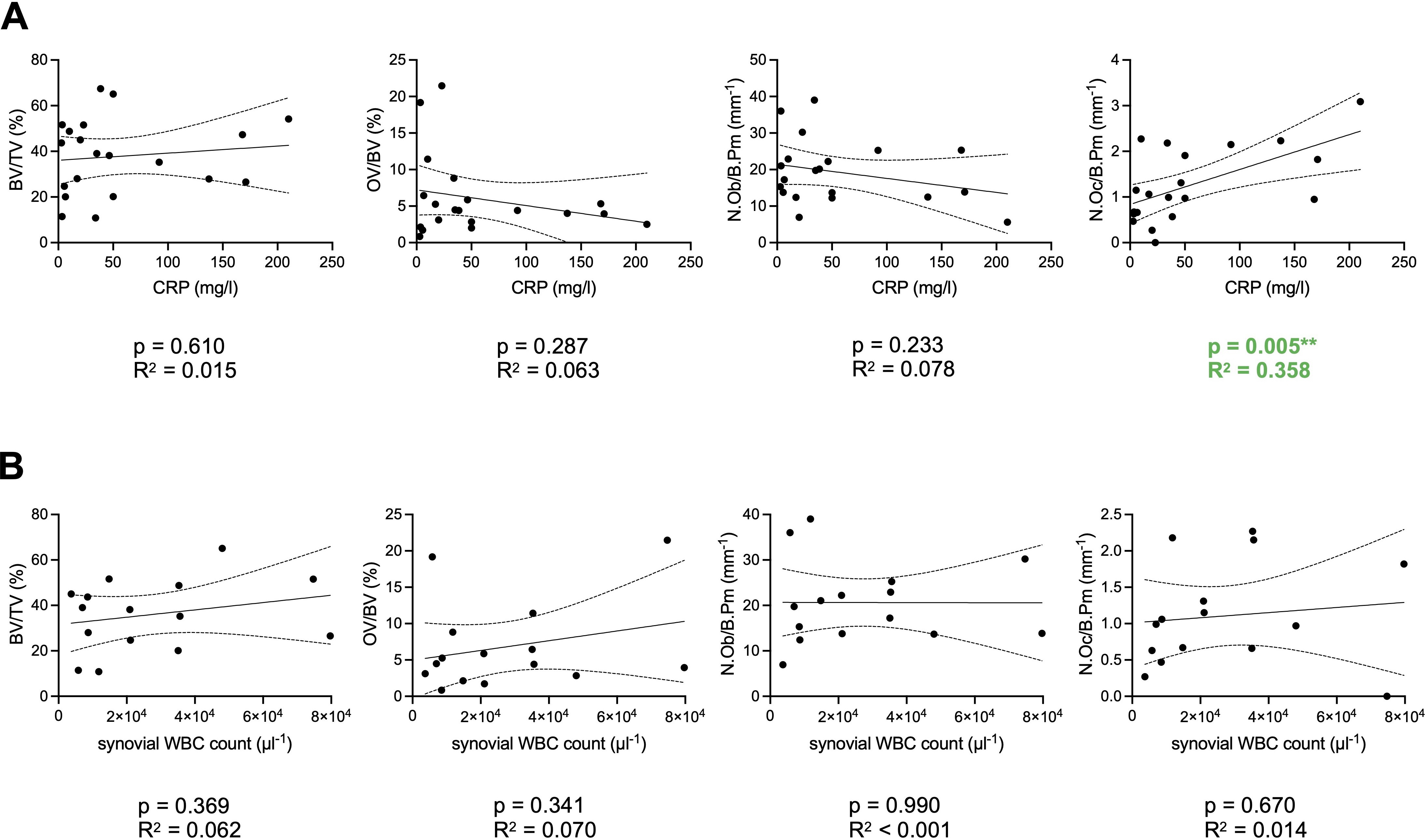 Fig. 4 
            Associations between laboratory inflammation markers and histological bone parameters in the periprosthetic joint infection group. a) Linear regression analysis between serum CRP and bone parameters (bone volume per tissue volume (BV/TV), osteoid volume per bone volume (OV/BV), number of osteoblasts per bone perimeter (N.Ob/B.Pm), number of osteoclasts per bone perimeter (N.Oc/B.Pm)) (n = 20). b) Linear regression analysis between synovial white blood cell (WBC) count and the same bone parameters (n = 15). Exact p-values (unless < 0.001) and R2 values are depicted. **p < 0.05.
          