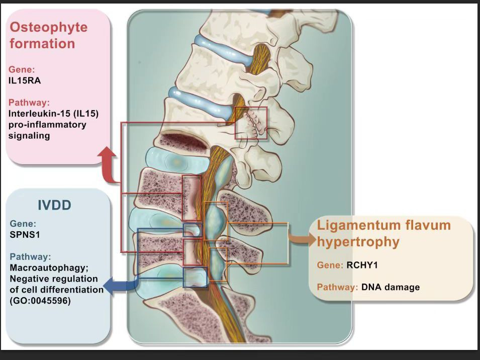 Fig. 5 
            The correlation between genetic variation and the three major pathological changes of lumbar spinal stenosis. GO, gene ontology; IL15-RA, interleukin-15 receptor α; IVDD, invertebral disc degeneration.
          