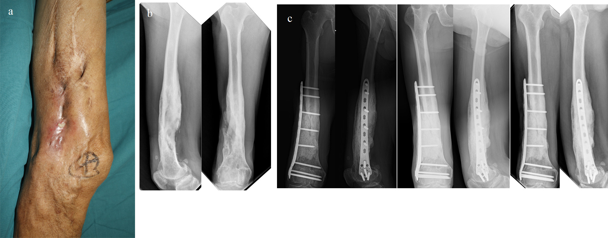 Fig. 2 
            Successful management of a 72-year-old male osteomyelitis patient in distal femur with an antibiotic‐loaded cement spacer (ALCS) for definitive treatment. a) Photograph presenting a sinus in distal, lateral side of the thigh. b) Anteroposterior and lateral radiographs before debridement. c) Radiographs of three, 12, and 24 months after an ALCS for definitive treatment, where the implants and cement spacer were in place with no excessive bone loss.
          