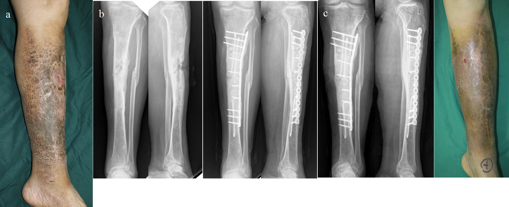 Fig. 3 
            Recurrent osteomyelitis patient (56 years old, male) with Pseudomonas aeruginosa infection in tibia shaft, who chose an antibiotic‐loaded cement spacer (ALCS) for definitive treatment. a) Photograph presenting a sinus in midshaft, anterior side of the tibia. b) Anteroposterior (AP) and lateral radiographs before and after operation of debridement and placing an ALCS for dead space. c) Radiographs (AP and lateral) and photograph showing a sign of recurrence at 13 months, where the sinus occured in a previous site.
          