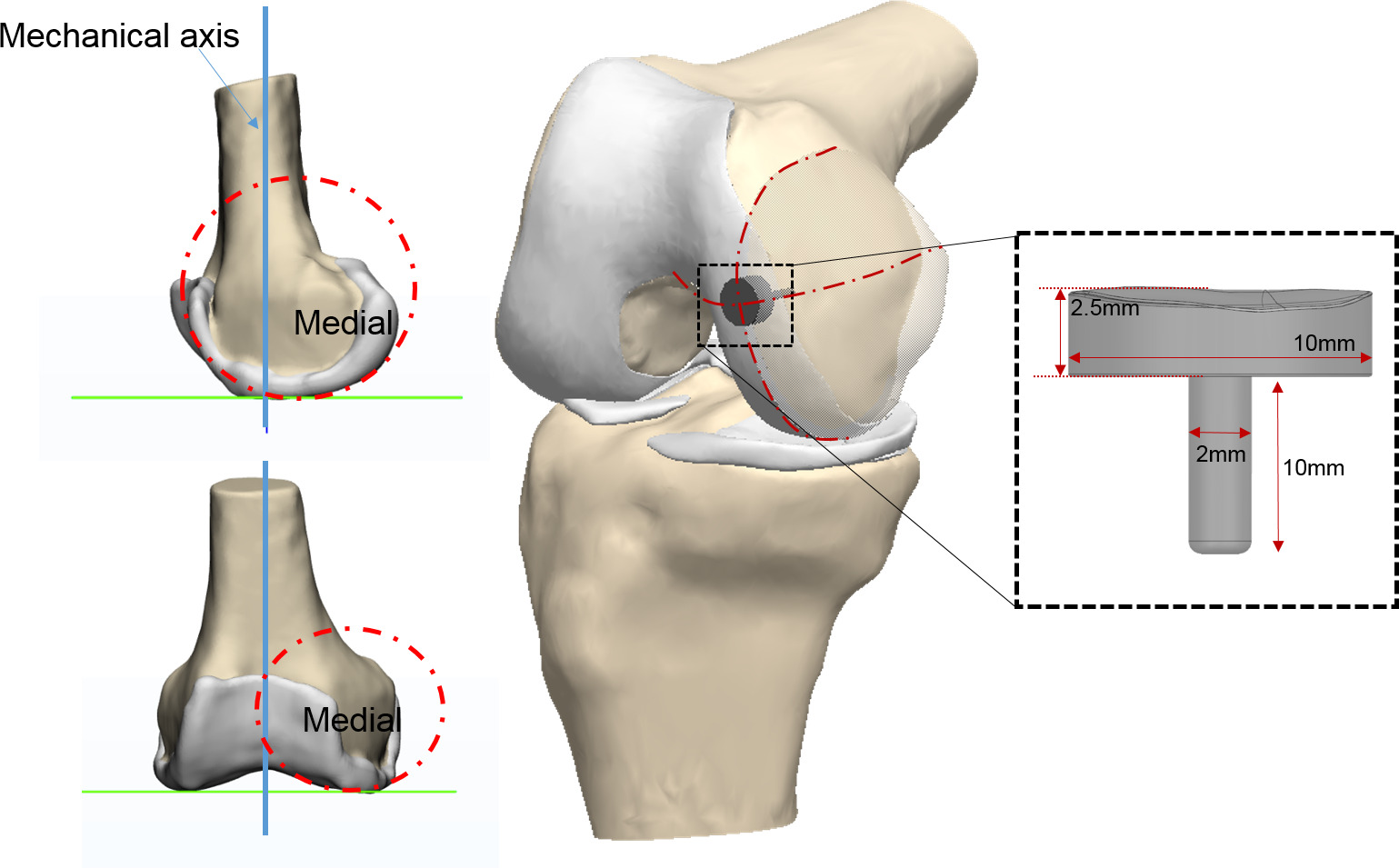 Fig. 1 
            Parameters and location in the implant geometry.
          