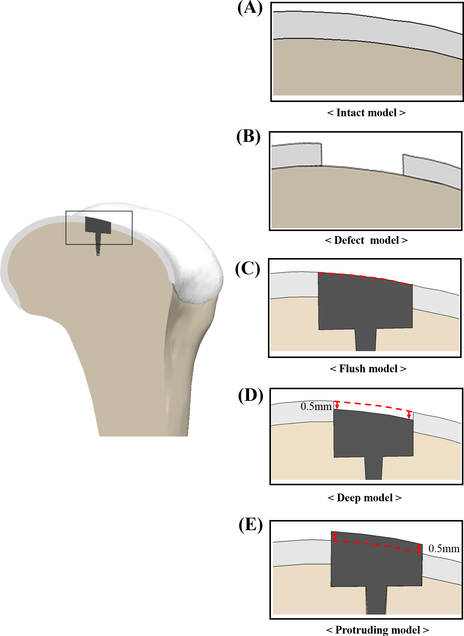 Fig. 2 
            Models of implants under three different insertion positions: a) intact model; b) defect model; c) flush model; d) 0.5 mm deep position compared to surrounding cartilage; and e) 0.5 mm protruding deep position compared to surrounding cartilage.
          