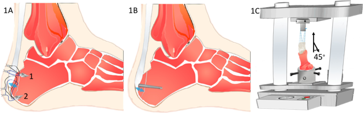 Fig. 1 
            a) The suture spanning technique with two suture anchors. The blue arrow marks the thickness of the fragment. b) Headless screw fixation for the calcaneal tuberosity fracture. c) The setting of the porcine heel on the material testing machine. To simulate the ankle joint in the postoperative protective condition, the tested angle between the tendon and the long axis of the calcaneal body was set at 45°.
          