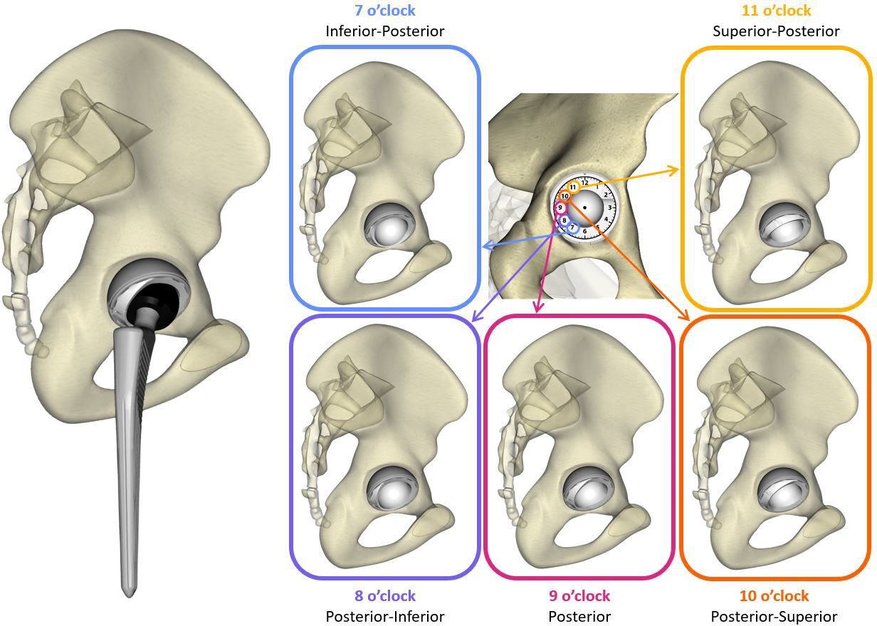 Fig. 1 
            Computer model of the implanted hip and lip orientations included in the study.
          