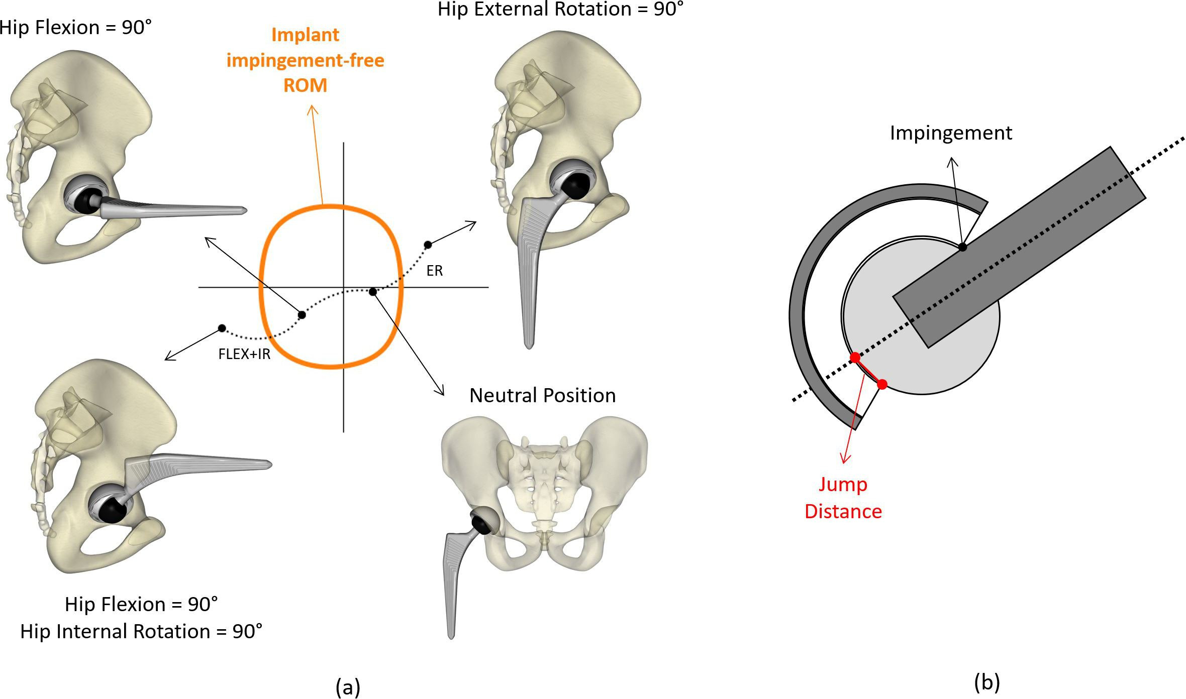 Fig. 3 
            a) Provocative dislocation manoeuvres as defined by Klemt et al,13 overlaid with the implant range of motion (ROM) to determine impingement occurrence. b) Jump distance at impingement calculated as the distance between the intersection of the stem neck axis on the liner and the liner edge. ER, external rotation until impingement; FLEX + IR, flexion to 90° followed by internal rotation until impingement.
          