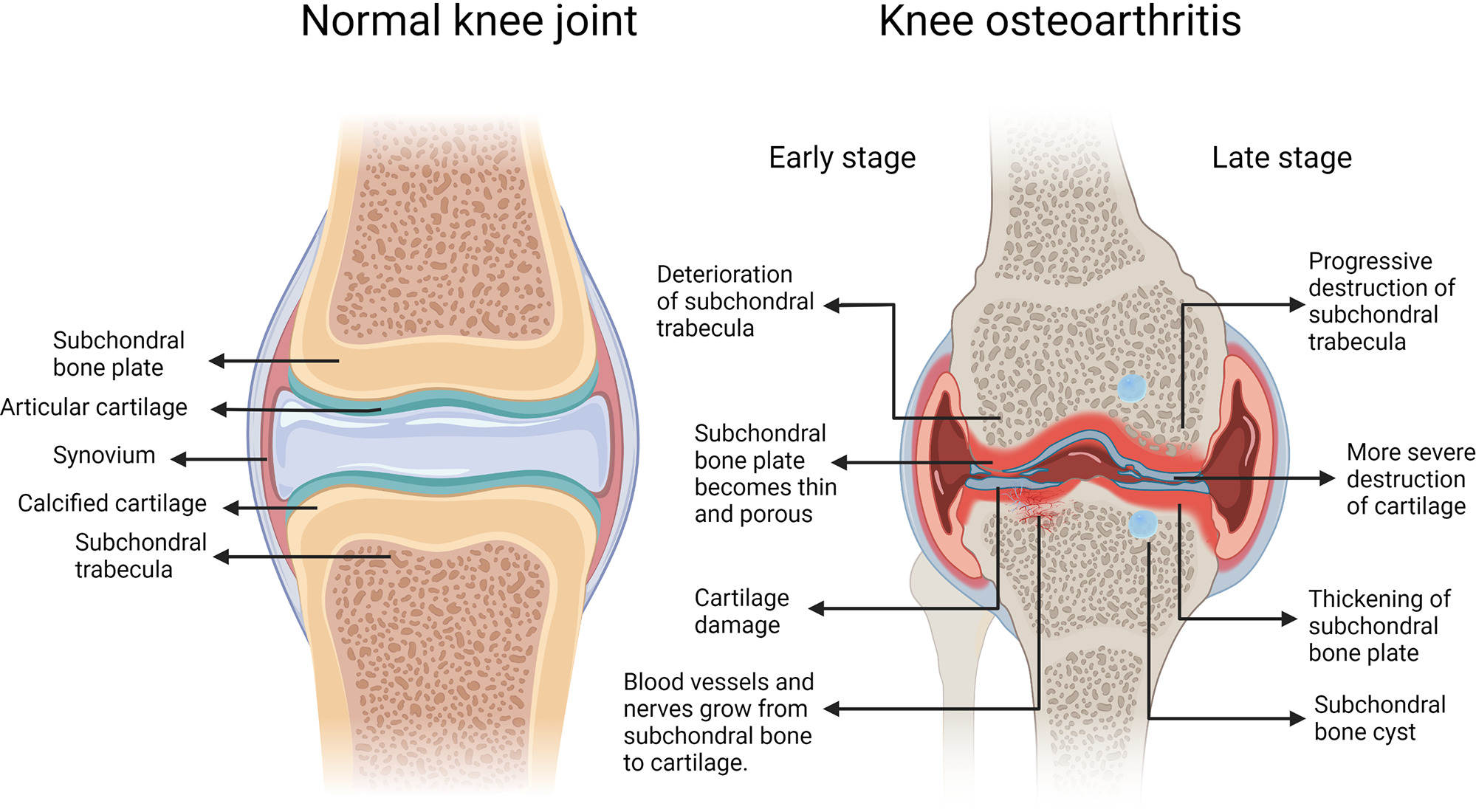 Fig. 1 
          Subchondral bone (SB) in normal joints and osteoarthritis (OA). Normal knee joints include cartilage, synovium, and SB. SB also includes subchondral bone plate (SBP) and subchondral trabecula. In early OA, the SBP becomes thinner and porous. Cartilage and SB trabeculae deteriorated. At the same time, blood vessels and nerves grow from subchondral bone to cartilage. In late OA, calcified cartilage appears in the articular cartilage area and the SBP thickens. At the same time, subchondral trabecular sclerosis and progressive cartilage destruction lead to bone cyst-like lesions.
        