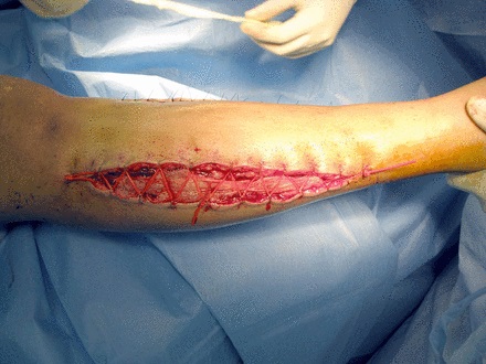 Fig. 1 
          Photograph showing an example
of vessel loop closure in a lower leg fasciotomy.
        