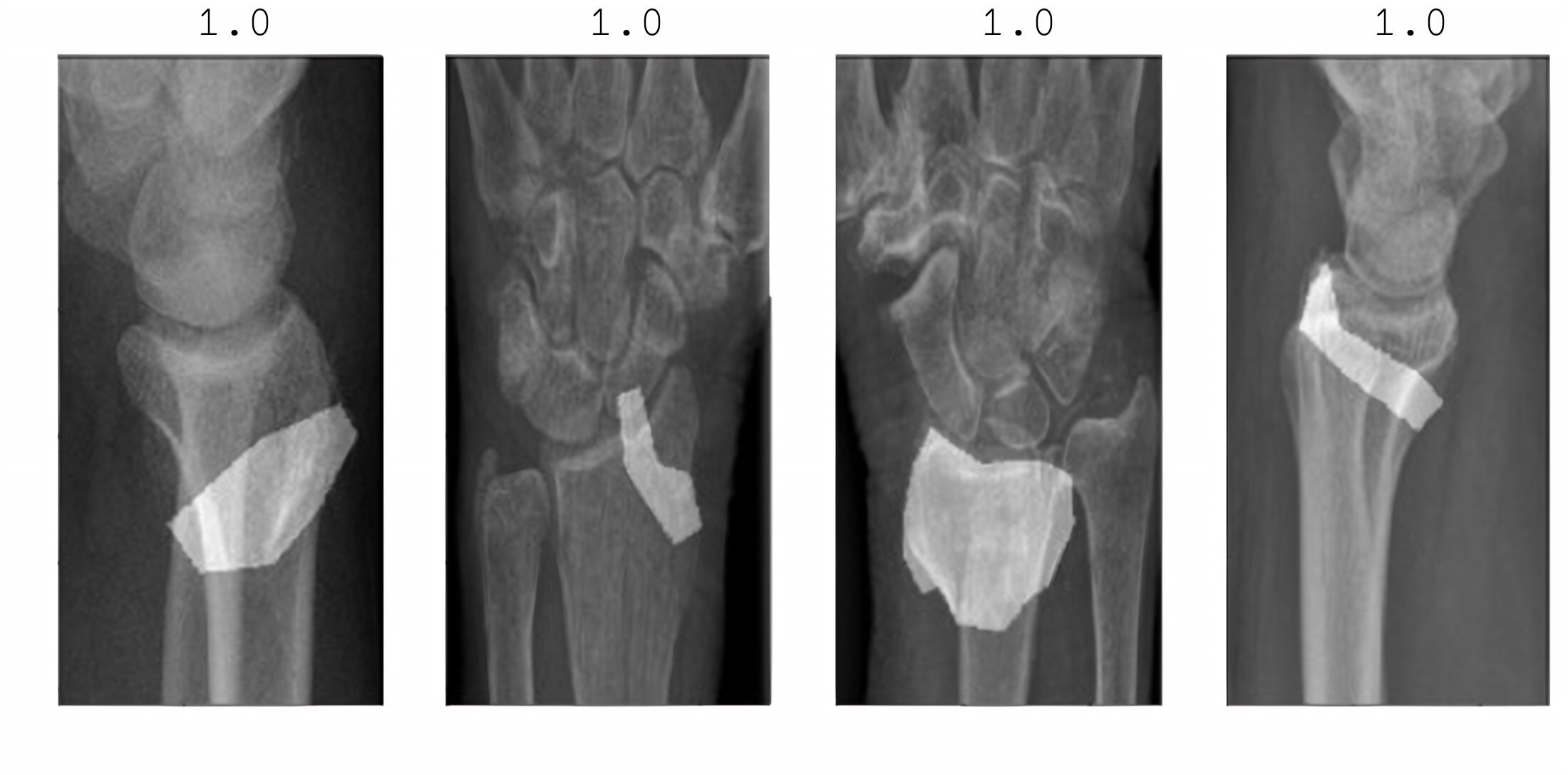 Fig. 1 
            Model prediction. The classification score above the image determines the diagnosis (fracture = 1, no fracture = 0). The segmentation mask determines the location of the fracture (drawn polygon).
          