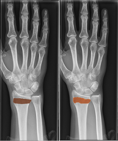 Fig. 2 
            Manually labelled fracture site (left) and model prediction (right).
          