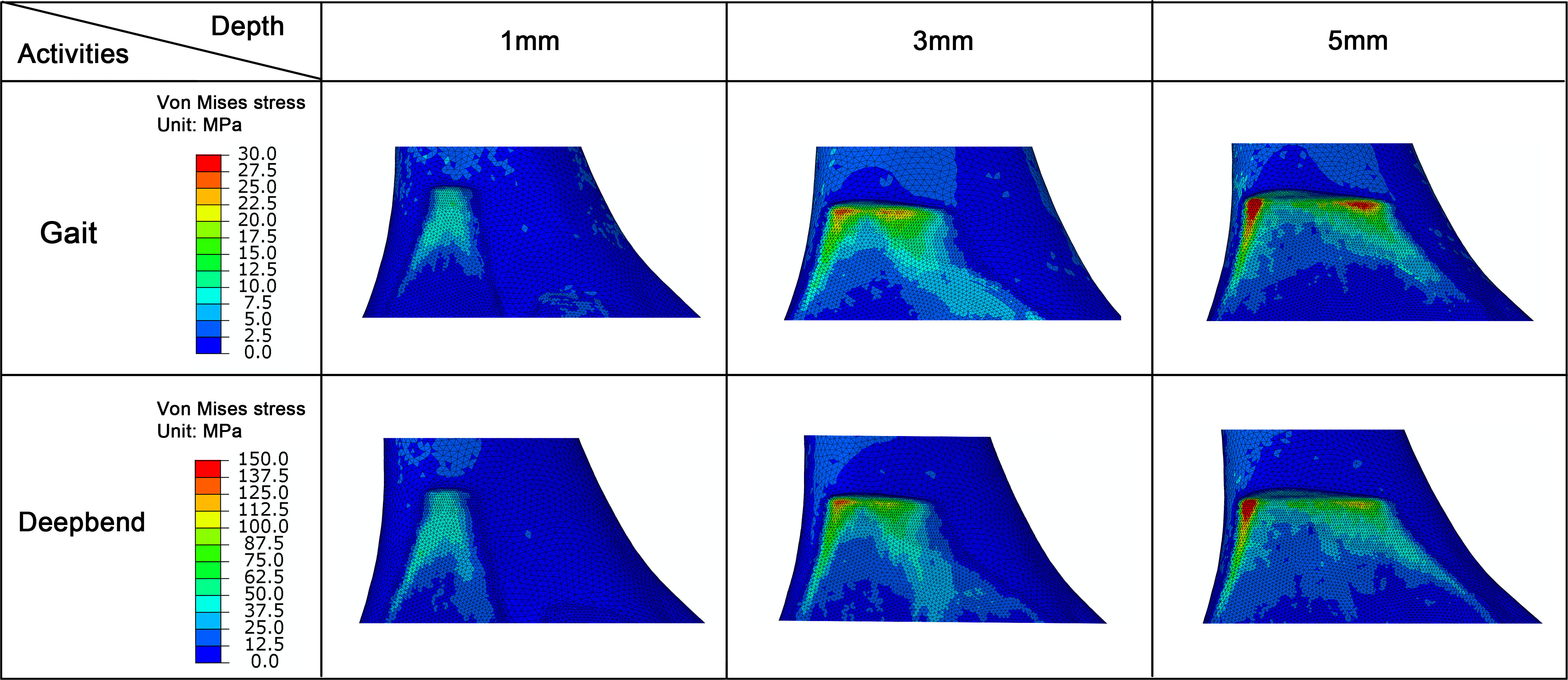 Fig. 6 
            The Von Mises stress distribution at the notching area when the notching depth was 1 mm, 3 mm, and 5 mm. The distance between the anterior flange of the femoral component and the notch (L) was 5 mm.
          