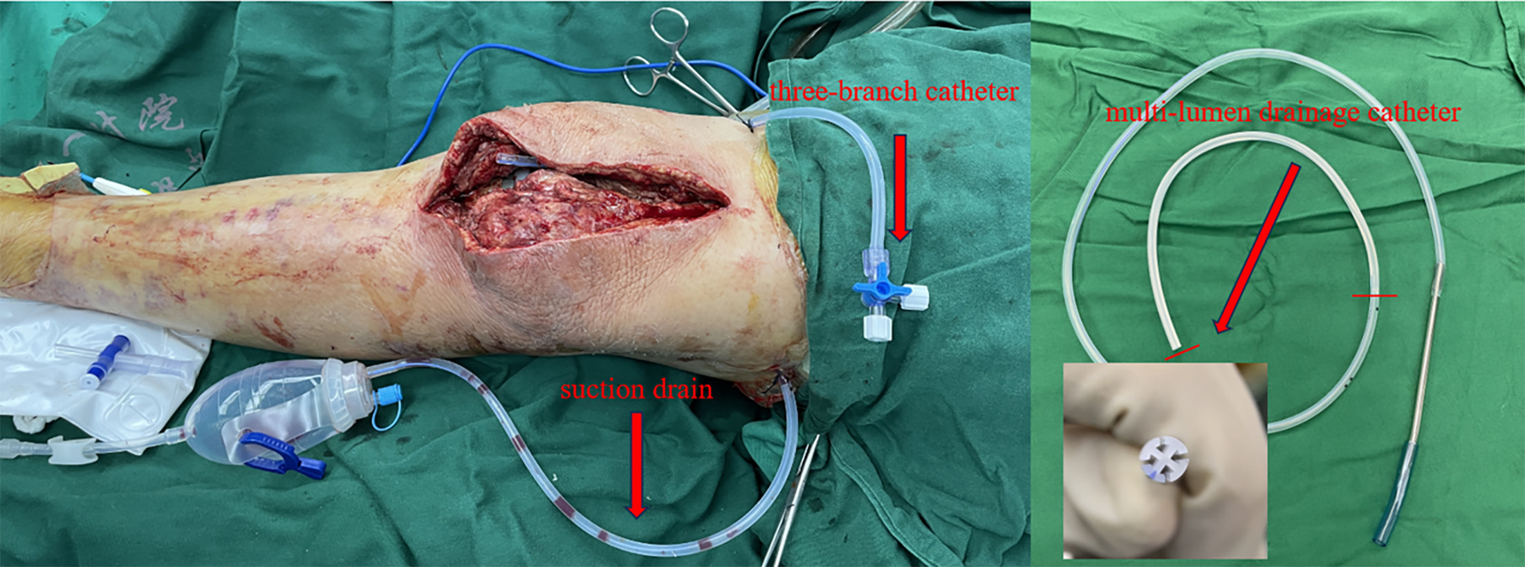 Fig. 2 
            Intra-articular suction drain and three-branch catheter were placed into the knee joint. The same approach was also applied to the hip joint.
          