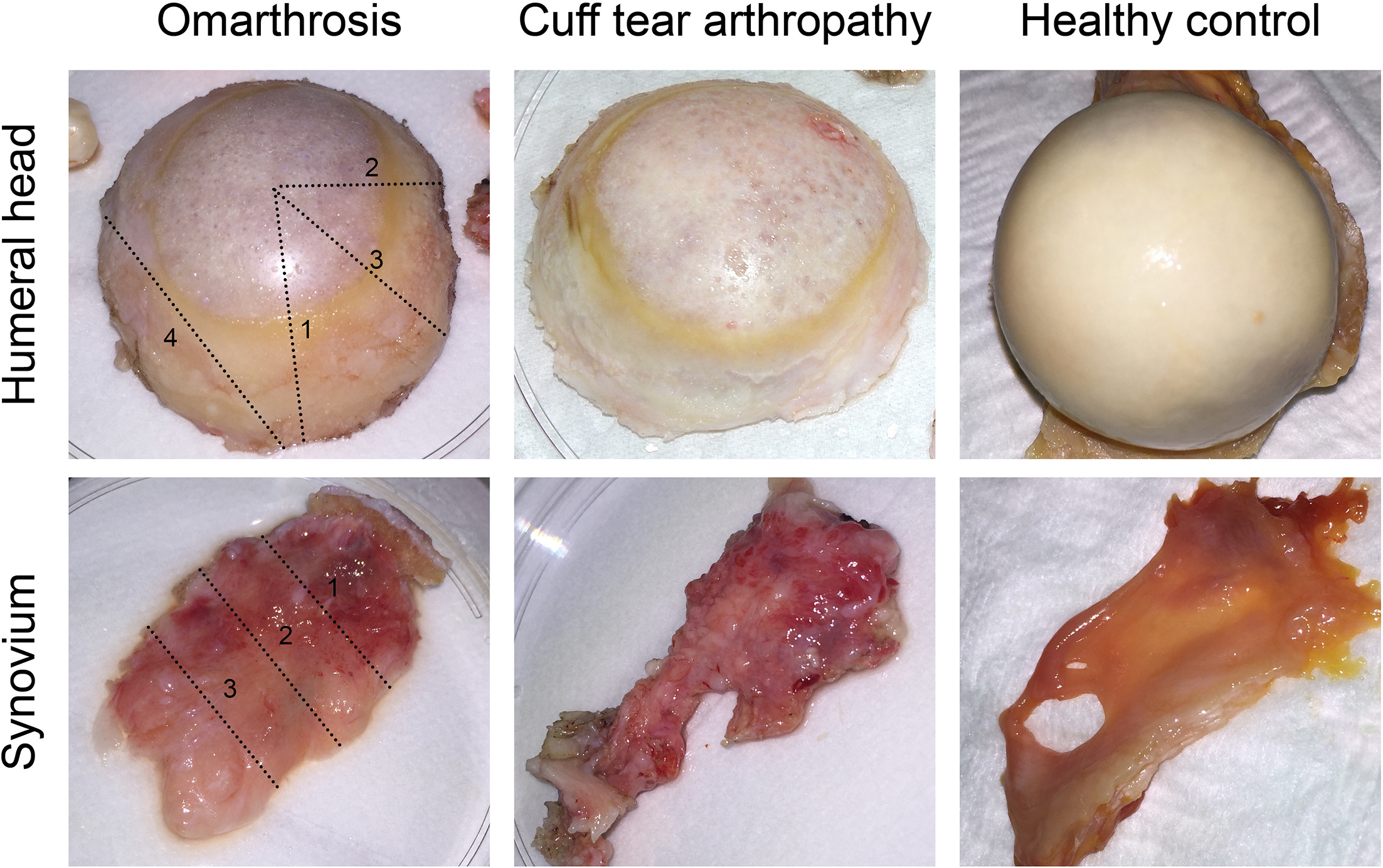 Fig. 1 
            Macroscopic appearance of clinical specimens. A total of 12 patients with omarthrosis (OmA) and seven patients with cuff tear arthropathy (CTA) were included in the study and compared to four healthy joints from three body donors. Images of representative tissue specimens of the humeral head and the synovium were obtained from OmA, CTA, and controls. The dashed lines indicate the four section plains that were used for histological analysis of each humeral head: 1) superior to inferior direction; 2) anterior to posterior direction; 3) at 45° to the superior/inferior line; and 4) across the peripheral zone of the humeral head. Similarly, three section planes were used across each specimen of synovial tissue.
          