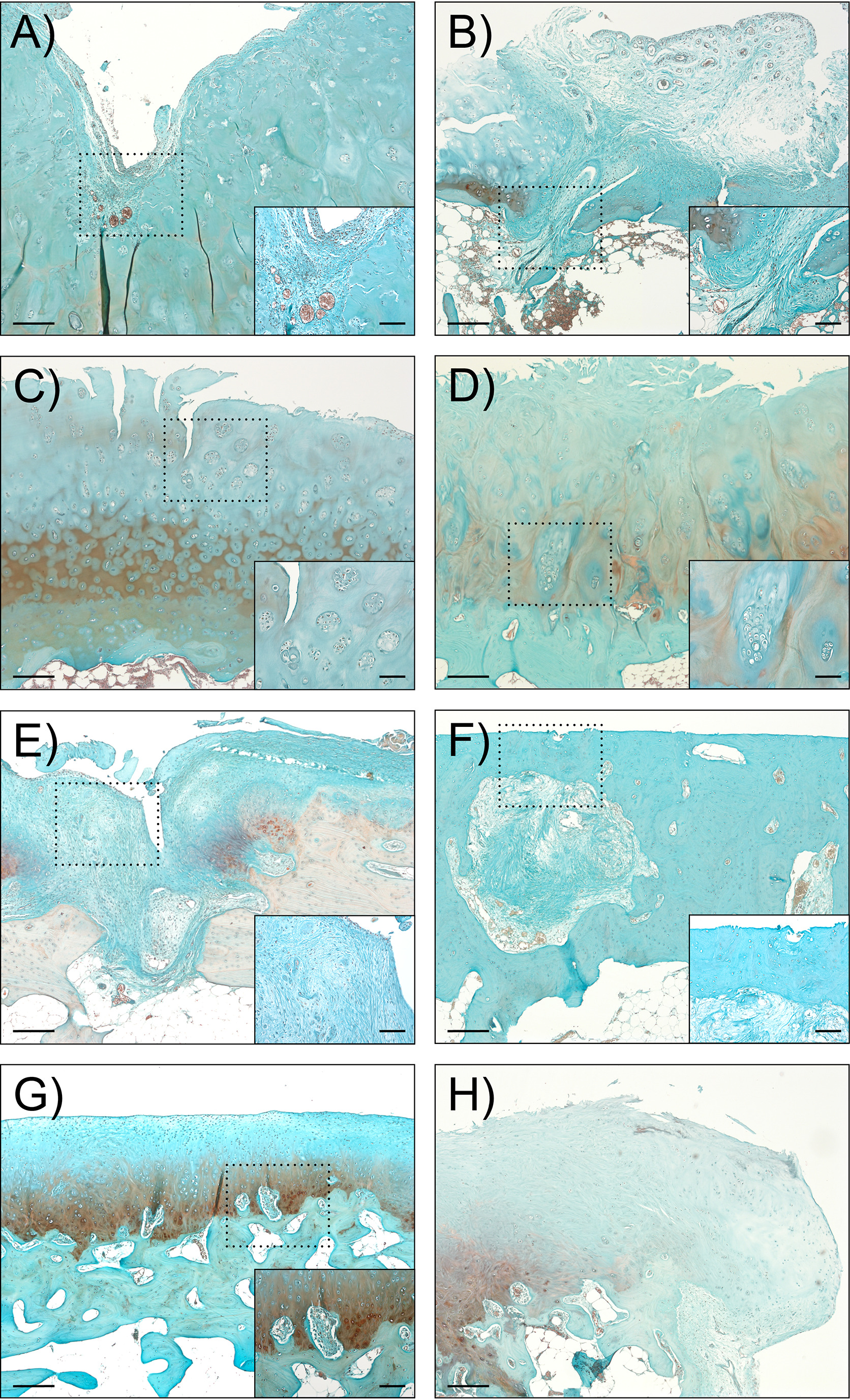 Fig. 2 
          Representative images of histopathological characteristics observed in humeral cartilage. Clinical specimens of humeral head cartilage were processed for histological staining with Safranin O and observed using light microscopy at 50× (large images) and 400× (inserts) magnification. a) Pannus formation with neovascularization eroding the surface of humeral cartilage. b) Pore formation in the subchondral bone plate. c) and d) Cell clusters in the c) superficial and d) deep zones of cartilage. e) Formation of fibrocartilage-like repair tissue. f) Bony eburnation and subchondral bone cyst. g) Blood vessels penetrating the tidemark. h) Osteophyte formation. Scale bars: 250 µm and 100 µm (inserts).
        