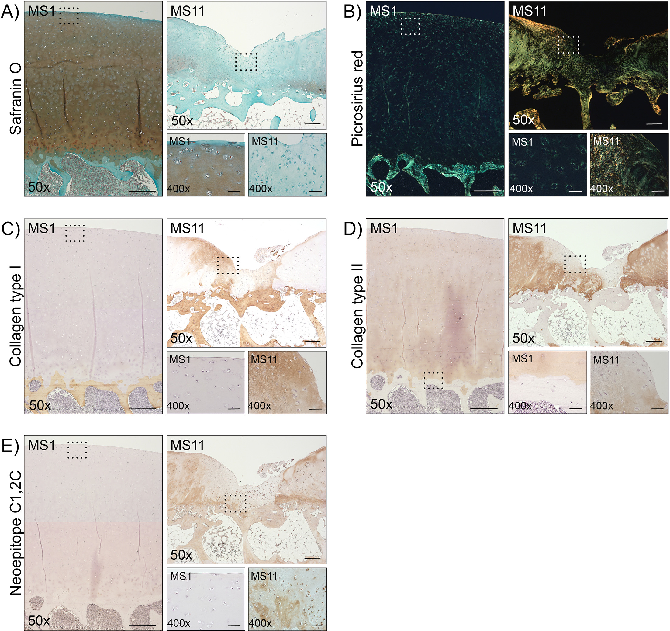 Fig. 4 
          Presence of matrix-associated markers in the degenerated humeral cartilage. Representative regions of intact (Mankin score (MS) 1) and severely degenerated cartilage (MS11) were selected and stained histologically with a) Safranin O and b) Picrosirius red, or immunohistochemically with specific antibodies against c) collagen type I, d) collagen type II, and e) the collagenase-generated neoepitope C1,2C. Stained sections were observed using light microscopy at 50× and 400× (inserts) magnification. Scale bars: 500 µm (MS1, 50×), 250 µm (MS11, 50×), 50 µm (400×).
        