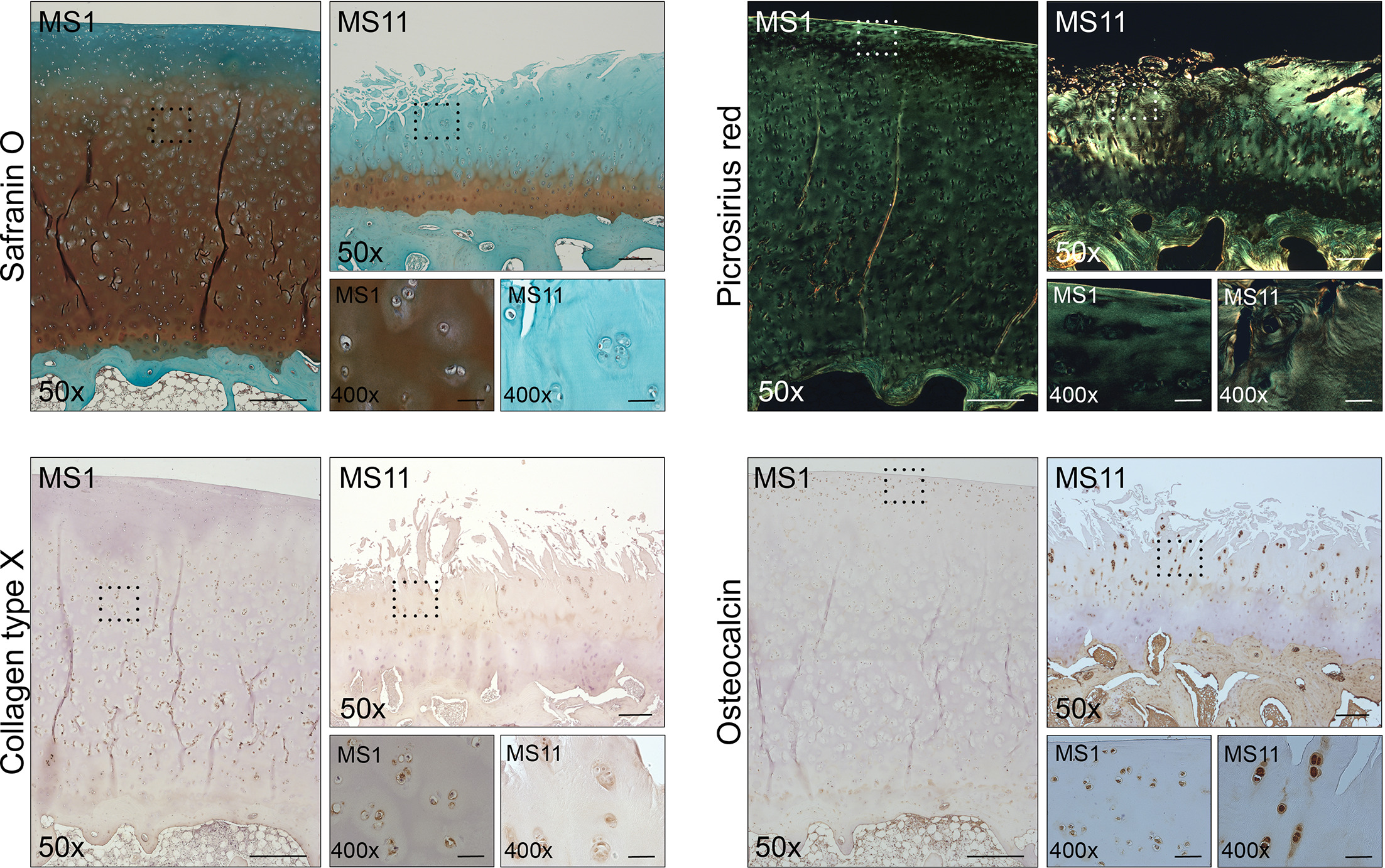 Fig. 5 
          Presence of chondrocyte hypertrophy-associated markers in the degenerated humeral cartilage. Representative regions of intact (MS1) and severely degenerated cartilage (MS11) were selected and stained histologically with a) Safranin O and b) Picrosirius red, or immunohistochemically with specific antibodies against c) collagen type X or d) osteocalcin. Stained sections were observed using light microscopy at 50× and 400× (inserts) magnification. Scale bars: 500 µm (MS1, 50×), 250 µm (MS11, 50×), 50 µm (400×).
        