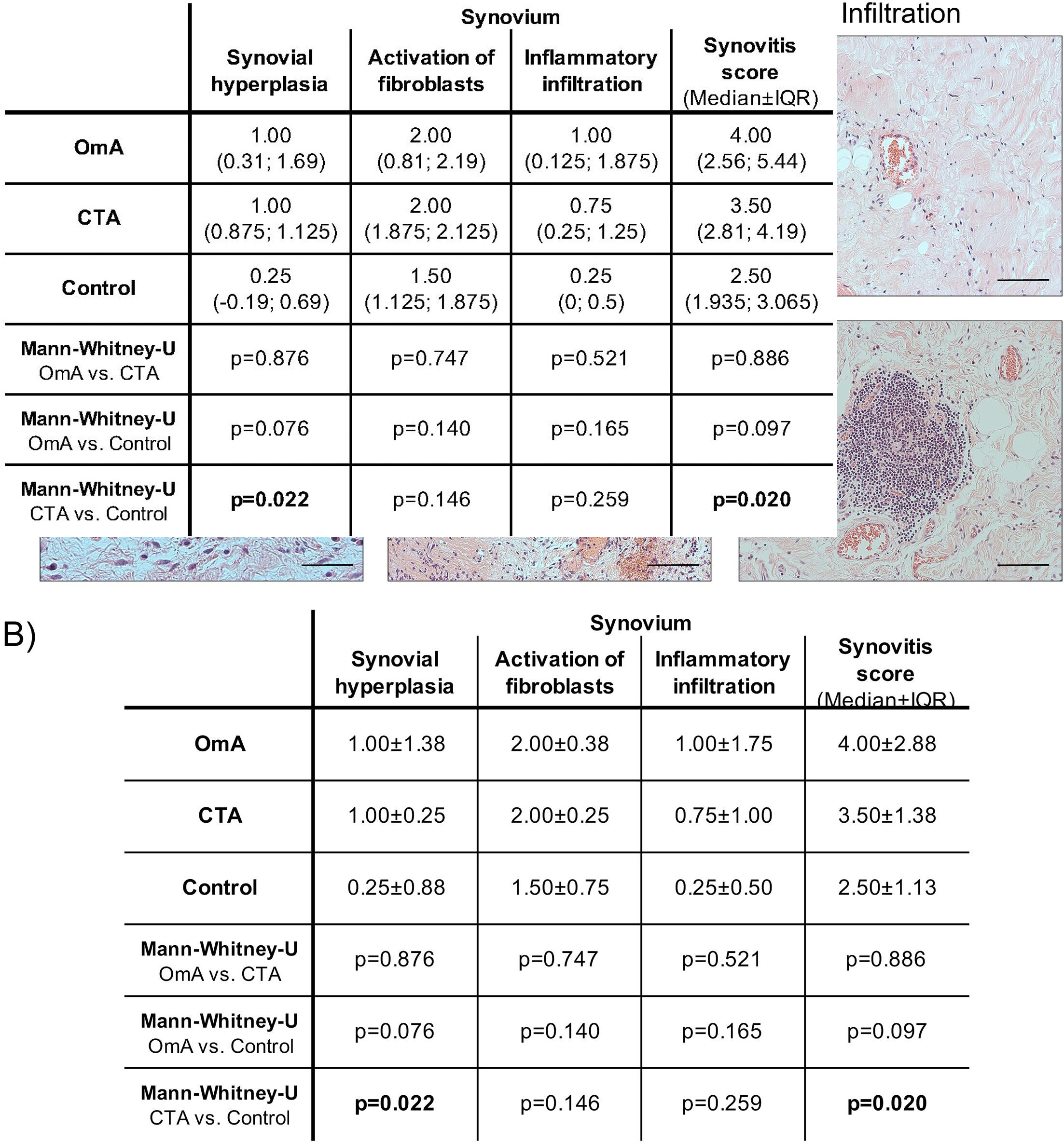 Fig. 7 
          Synovitis scores of omarthrosis (OmA), cuff tear arthropathy (CTA), and control tissues. a) Representative images of the synovial lining, the synovial stroma, and inflammatory infiltrations in control and OmA tissues. The control case represents the absence of synovitis with a normal synovial lining cell layer (one to two cell layers thick), normal cell distribution in the stroma, and slight infiltrations (diffusely distributed and aggregated immune cells). The sum of parameters is 1 out of 9, inflammatory grade = 1. The OmA case represents strong synovitis with strong enlargement of the synovial lining layer (more than five cell layers thick), moderate stroma activation, and moderate inflammatory infiltration (medium-sized lymphatic follicles without germinal centre). The sum of parameters is 7 out of 9, inflammatory grade = 3. Scale bars: 50 µm. b) Semiquantitative evaluation of the three histopathological parameters and total synovitis in OmA (n = 12), CTA (n = 6), and controls (n = 4) was performed using the Krenn score. Presented are the median values with 25th and 75th percentiles in brackets. Statistical analyses were performed using the Mann-Whitney U test. Exact p-values are given, and p-values < 0.05 are displayed in bold font.
        