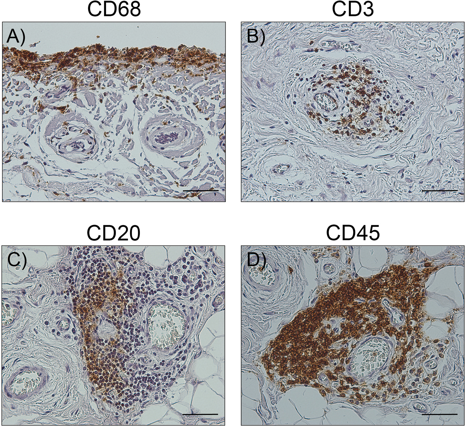 Fig. 8 
          Immunohistochemical staining of inflammed synovial tissue. Clinical specimens of synovial tissue from a representative omarthrosis (OmA) patient were histologically processed and stained with antibodies against a) CD68, b) CD3, c) CD20, or d) CD45. Immunopositive cells are shown in brown colour. Scale bars: 50 µm.
        