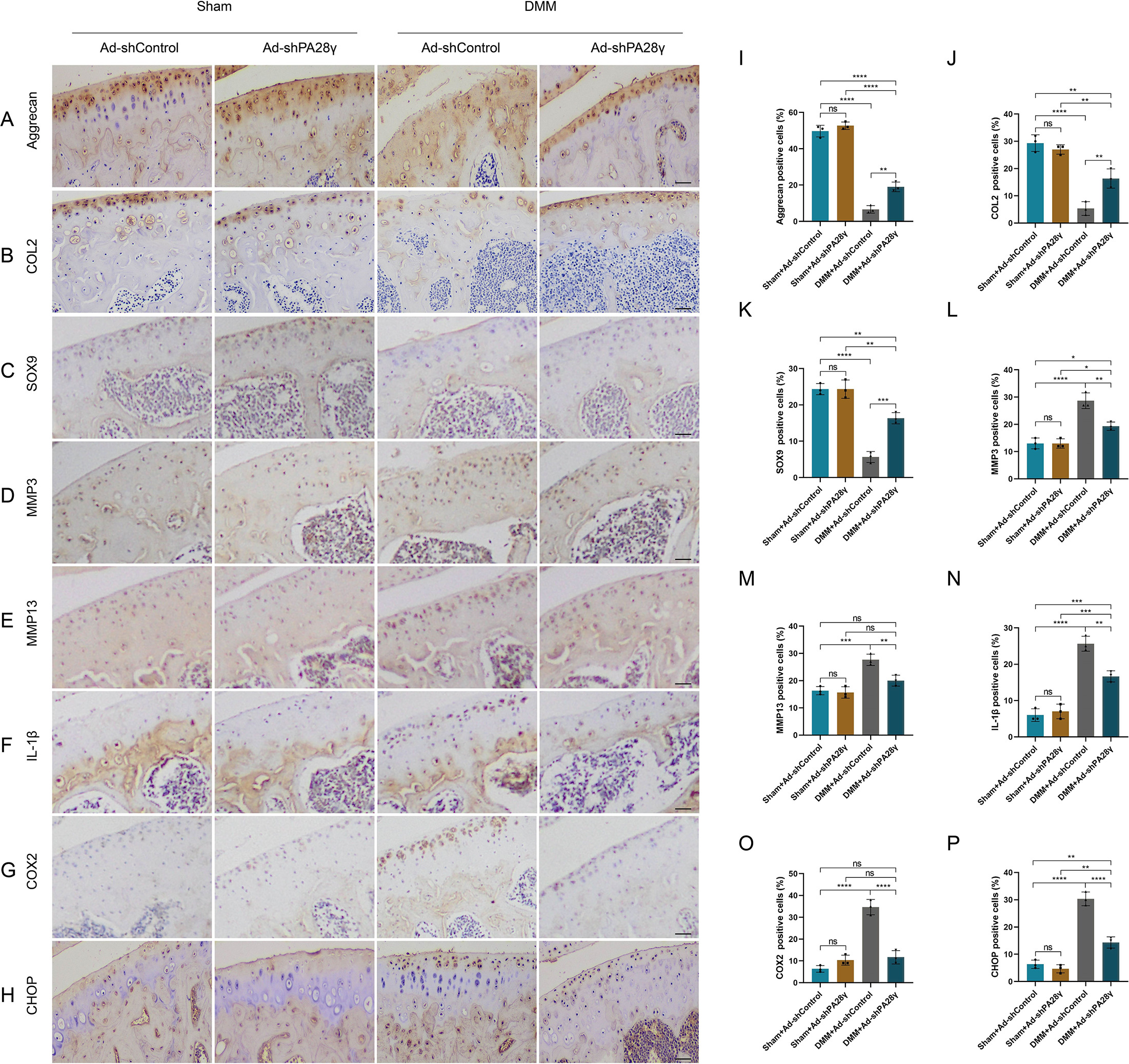 Fig. 8 
            Knockdown of PA28γ alleviates osteoarthritis (OA) after destabilized medial meniscus (DMM) surgery. a) and i) Aggrecan immunohistochemical staining images and quantitative data of knee joint tissue obtained from Ad-shControl and Ad-shPA28γ mice eight weeks after DMM surgery, measuring scale = 100 μm (n = 3, **p < 0.01, ****p < 0.0001). b) and j) Type II collagen (COL2) immunohistochemical staining images and quantitative data of knee joint tissue obtained from Ad shControl and Ad-shPA28γ mice eight weeks after DMM surgery, measuring scale = 100 μm (n = 3, **p < 0.01, ****p < 0.0001). c) and k) SOX9 immunohistochemical staining images and quantitative data of knee joint tissue obtained from Ad-shControl and Ad-shPA28γ mice eight weeks after DMM surgery, measuring scale = 100 μm (n = 3, **p < 0.01, ***p < 0.001, ****p < 0.0001). d) and l) Matrix metalloproteinase 3 (MMP3) immunohistochemical staining images and quantitative data of knee joint tissue obtained from Ad-shControl and Ad-shPA28γ mice eight weeks after DMM surgery, measuring scale = 100 μm (n = 3, *p < 0.05, **p < 0.01, ****p < 0.0001). e) and m) MMP13 immunohistochemical staining images and quantitative data of knee joint tissue obtained from Ad-shControl and Ad-shPA28γ mice eight weeks after DMM surgery, measuring scale = 100 μm (n = 3, **p < 0.01, ***p < 0.001). f) and n) Interleukin-1β (IL-1β) immunohistochemical staining images and quantitative data of knee joint tissue obtained from Ad-shControl and Ad-shPA28γ mice eight weeks after DMM surgery, measuring scale = 100 μm (n = 3, **p < 0.01, ***p < 0.001, ****p < 0.0001). g) and o) COX2 immunohistochemical staining images and quantitative data of knee joint tissue obtained from Ad-shControl and Ad-shPA28γ mice eight weeks after DMM surgery, measuring scale = 100 μm (n = 3, ****p < 0.0001). h) and p) CHOP immunohistochemical staining images and quantitative data of knee joint tissue obtained from Ad-shControl and Ad-shPA28γ mice eight weeks after DMM surgery, measuring scale = 100 μm (n = 3, **p < 0.01, ****p < 0.0001). ns, not specified.
          