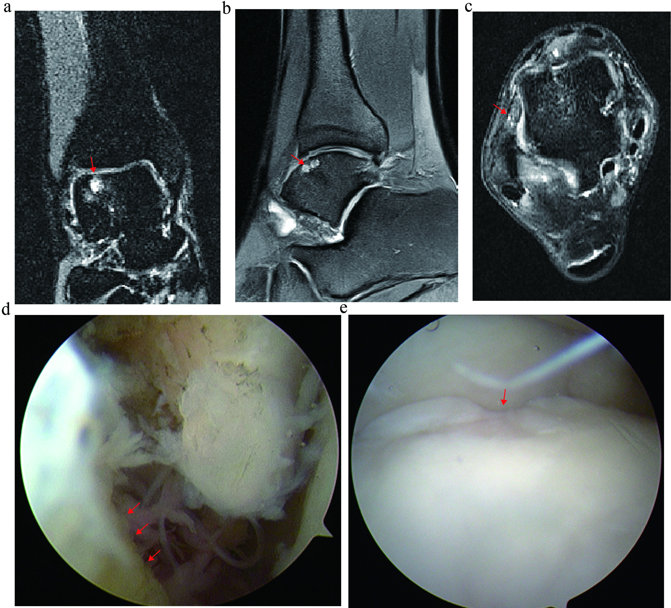 Fig. 1 
          Patient with chronic ankle instability (CAI) and osteochondral lesion of the talus (OLT) included in the current study based on MRI and subsequent arthroscopic evaluation. a) Coronal MRI image showing OLT on the medial shoulder of the talus. Red arrow: OLT. b) Sagittal MRI image showing OLT on the talus. Red arrow: OLT. c) Transverse MRI image showing anterior talofibular ligament thickening and slacking. Red arrow: anterior talofibular ligament. d) Arthroscopic assessment showing scar tissue on the anterior talofibular ligament fibre. Red arrow: anterior talofibular ligament. e) Arthroscopic assessment showing OLT on the medial shoulder of the talus. Red arrow: OLT.
        