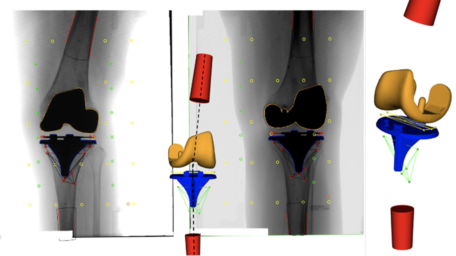 Fig. 4 
            Stereoradiograph with projections of the surfaces of the femoral (orange) and tibial (blue) components, the tantalum markers in the polyethylene inlay (yellow marker model), and in the tibial bone (green marker model). The red cones represent the femur and tibia bones and their coordinate systems (y-axis) for estimation of the anatomical knee axis.
          