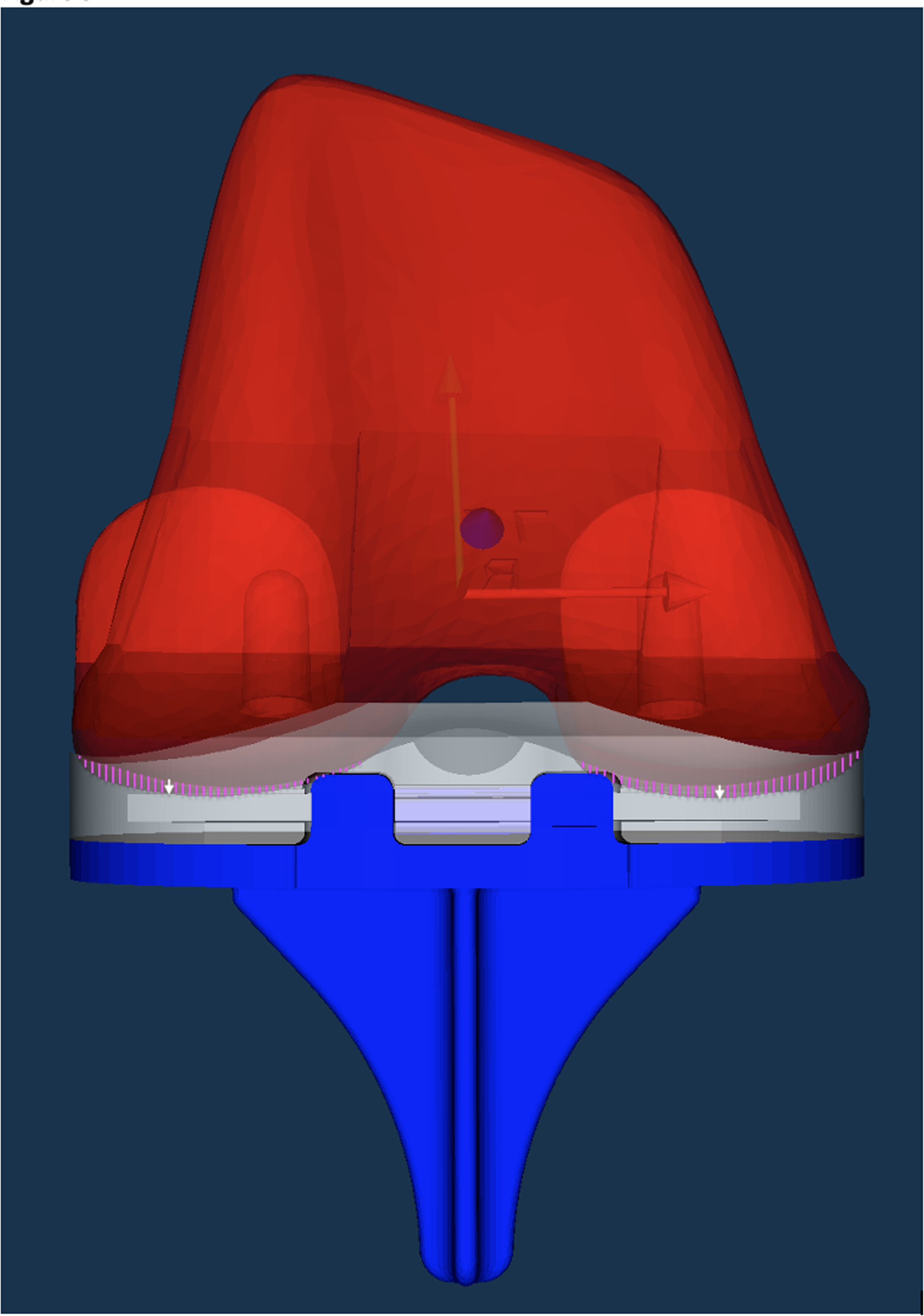 Fig. 5 
            View of the computer-aided design models of the femoral component (red), the polyethylene (PE) inlay (white), and the tibial component (blue). The white arrows indicate the point of deepest penetration of the femoral component into the PE inlay at mean six years’ follow-up (minimum joint space width), which reflects the mean PE wear (mm) in the medial and lateral compartments separately (n = 23). Pink shades indicate penetration area.
          