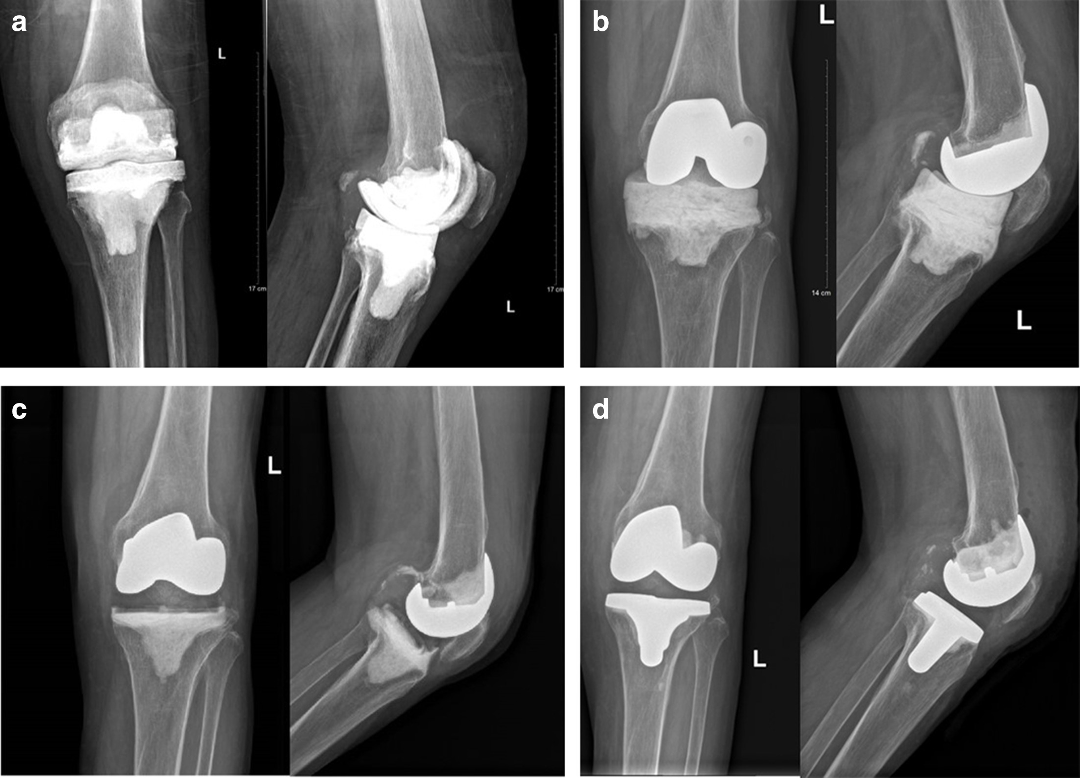 Fig. 1 
          Anteroposterior and lateral radiographs of different types of knee spacers. a) An 82-year-old male patient with a cement spacer one week after revision. b) A 72-year-old female patient with a metal-cement spacer one week after revision. c) A 62-year-old male patient with a metal-polyethylene spacer one week after revision. d) A 72-year-old male patient with primary arthroplasty implants as a spacer one week after revision.
        