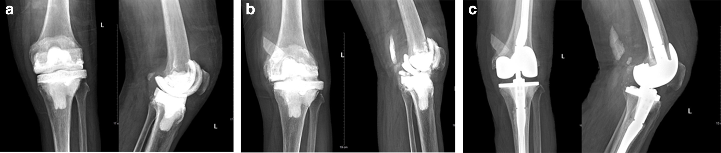 Fig. 3 
          Anteroposterior and lateral radiographs of a patient who underwent reimplantation three years after first-stage revision because of a cement spacer fracture. a) An 82-year-old male patient with a cement spacer one week after the first-stage revision. b) An 85-year-old male patient with a fractured cement spacer three years after the first-stage revision during the follow-up. c) An 85-year-old male patient with revision prostheses one week after reimplantation.
        