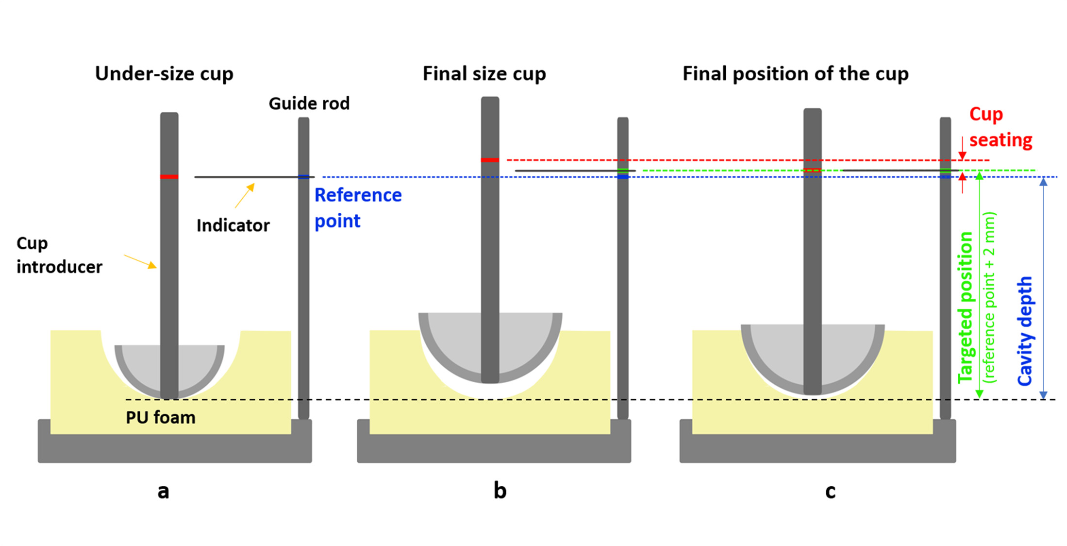 Fig. 2 
            Defining the final position of the cup. a) The depth of the CNC-milled cavity was referenced from a mark on the cup introducer (red) to an indicator on the guide rod (blue) without harming the reamed surface using an under-sized cup. b) The indicator was then moved 2 mm above the reference point on the guide rod to define the targeted cup position with a corresponding polar gap (green). c) Final position of the implanted acetabular cup. PU, polyurethane.
          