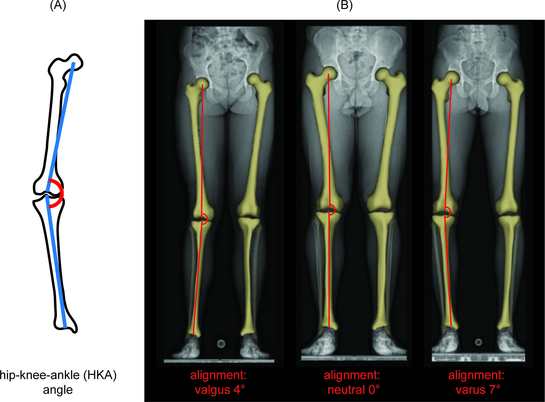 Fig. 1 
            a) Schematic illustration of the hip-knee-ankle (HKA) angle definition used by the SterEOS software (EOS imaging, France). b) Exemplary visualization of the reconstructed 3D bone models of the femur and tibia by the SterEOS software and the resulting limb alignment for a valgus (left), neutral (middle), and varus (right) subject.
          