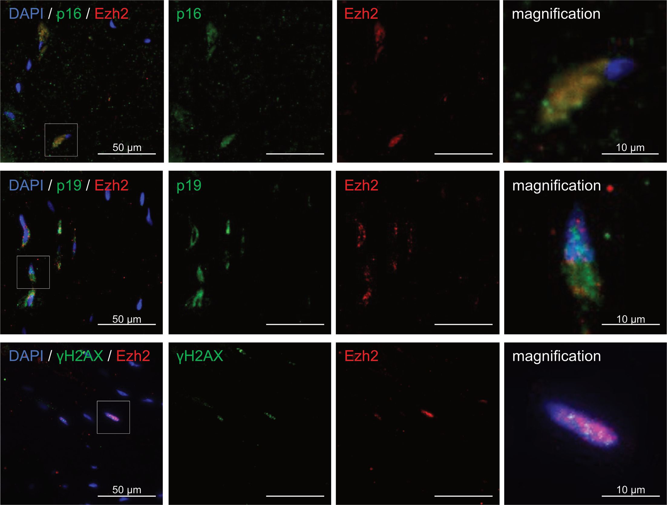 Fig. 5 
            Representative immunofluorescent co-stainings of Enhancer of Zeste 2 (EZH2) with p16 (upper row), p19 (middle row), and γH2AX (lower row) for a rotator cuff tear (RCT) biopsy. Nuclear staining was performed with 4',6-diamidino-2-phenylindole (DAPI). Images at the right show a magnification of the area with a selected tenocyte, indicated by a white box on the left. Scale bars equal 50 μm unless otherwise indicated.
          