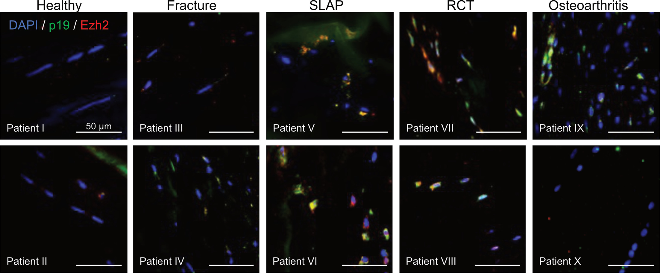 Fig. 6 
            Immunofluorescent co-stainings of Enhancer of Zeste 2 (EZH2) and p19. For each group, stainings of two individual patient samples are shown; images are representative for that patient sample. Scale bars equal 50 μm. DAPI, 4',6-diamidino-2-phenylindole; RCT, rotator cuff tear; SLAP, superior labrum anterior to posterior tear.
          