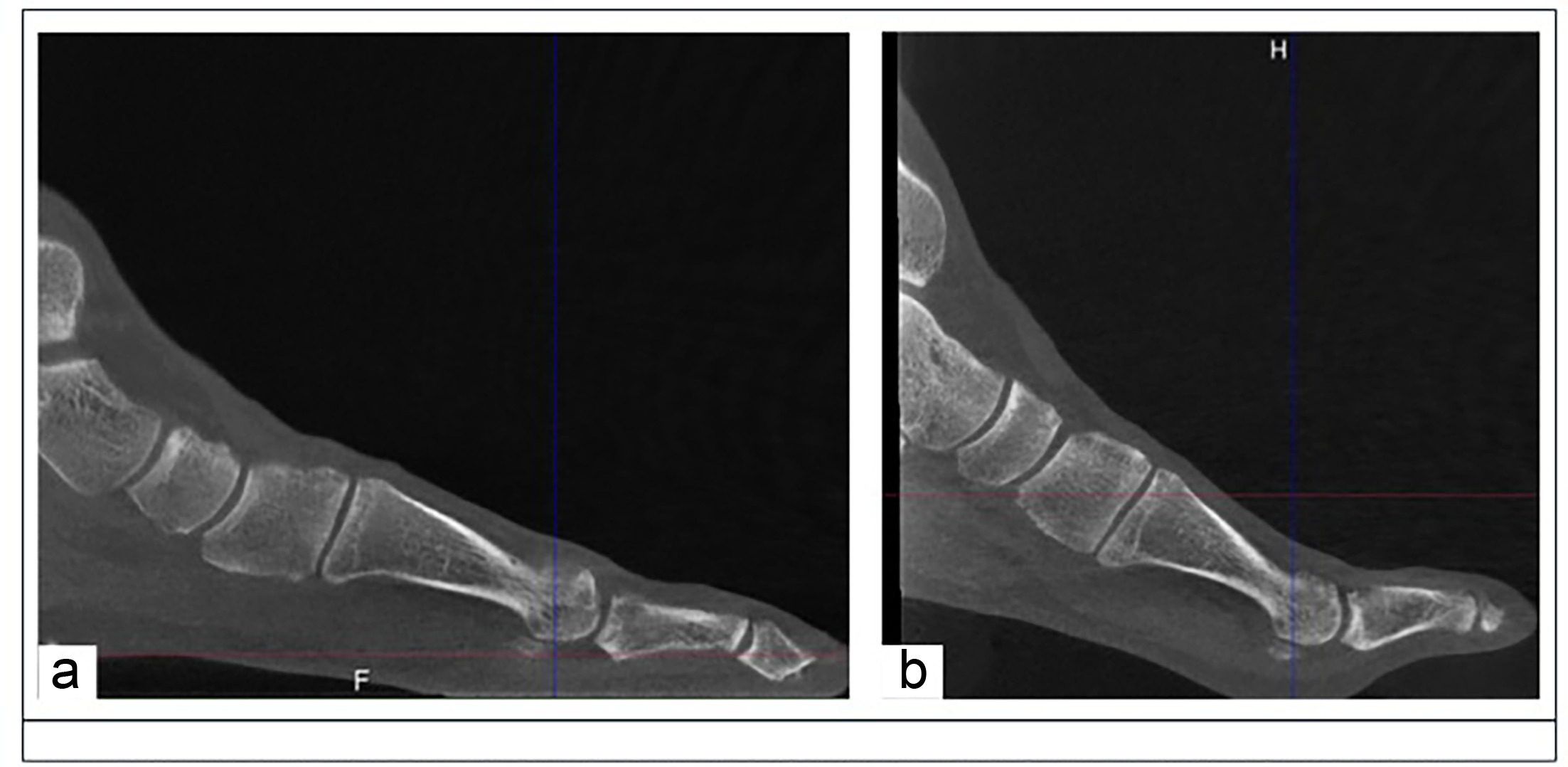 Fig. 1 
          a) Foot positioned in the standard weightbearing (SWB) position. b) Foot positioned in the sesamoid view (SV) position, with the toes in dorsiflexion.
        