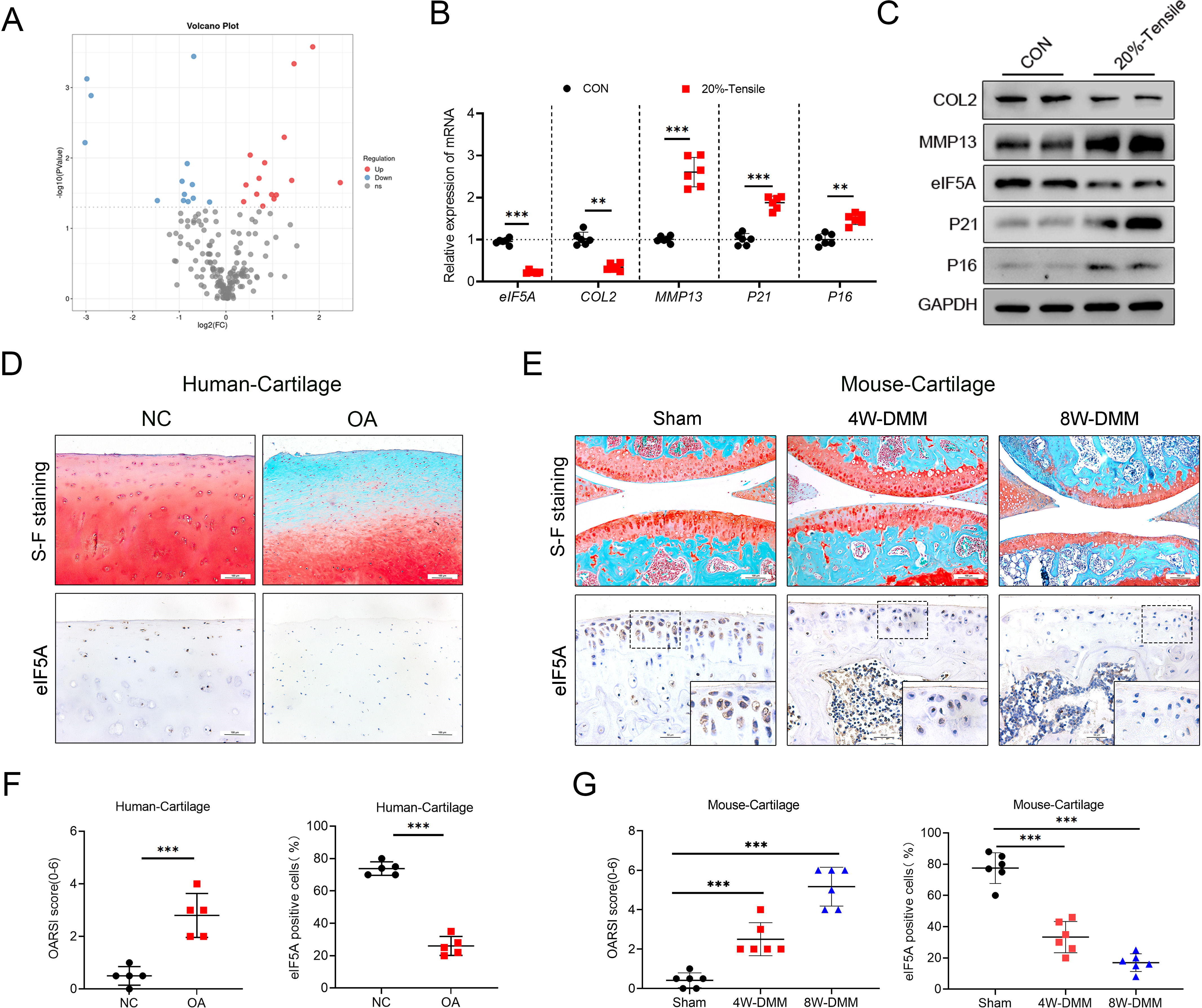 Fig. 1 
            Eukaryotic translation initiation factor 5A (eIF5A) is reduced in articular cartilage in osteoarthritis (OA) patients and OA mice. a) Volcano plots of differentially expressed genes after stretching. b) Quantitative polymerase chain reaction (qPCR) analysis of eIF5A, type II collagen (COL2), matrix metalloproteinase 13 (MMP13), P21, and P16 in primary chondrocytes treated with 20% cyclic tensile strain for 24 hours; n = 6 per group. c) Western blot (WB) analysis of eIF5A, COL2, and MMP13 in primary chondrocytes treated with 20% cyclic tensile strain for 24 hours. Glyceraldehyde-3-phosphate dehydrogenase (GAPDH) was used as the loading control. d) Safranin O/Fast Green staining (upper) and immunohistochemistry (IHC) staining of eIF5A (lower) of human knee cartilage from the medial (OA) and lateral (controls) tibial plateau of OA patients. Scale bar: 100 µm. e) Safranin O/Fast Green staining (upper) and IHC of eIF5A (lower) of control group (CON) and destabilization of the medial meniscus (DMM) knee cartilage of C57 mouse. Knee tissue was obtained at four and eight weeks (4W and 8W) after the DMM procedure. Scale bars: 100 µm, 50 µm. f) Osteoarthritis Research Society International (OARSI) grades for human articular cartilage of the medial and lateral tibial plateau in Fig. 1c and quantification of eIF5A in each group; n = 6 per group. g) OARSI grades for the joints described in Fig. 1e and quantification of eIF5A in each group; n = 6 per group. An independent-samples t-test and one-way analysis of variance were used for statistical analyses (*p < 0.05, **p < 0.01, ***p < 0.001). FC, fold change; NC, negative control; ns, not significant.
          