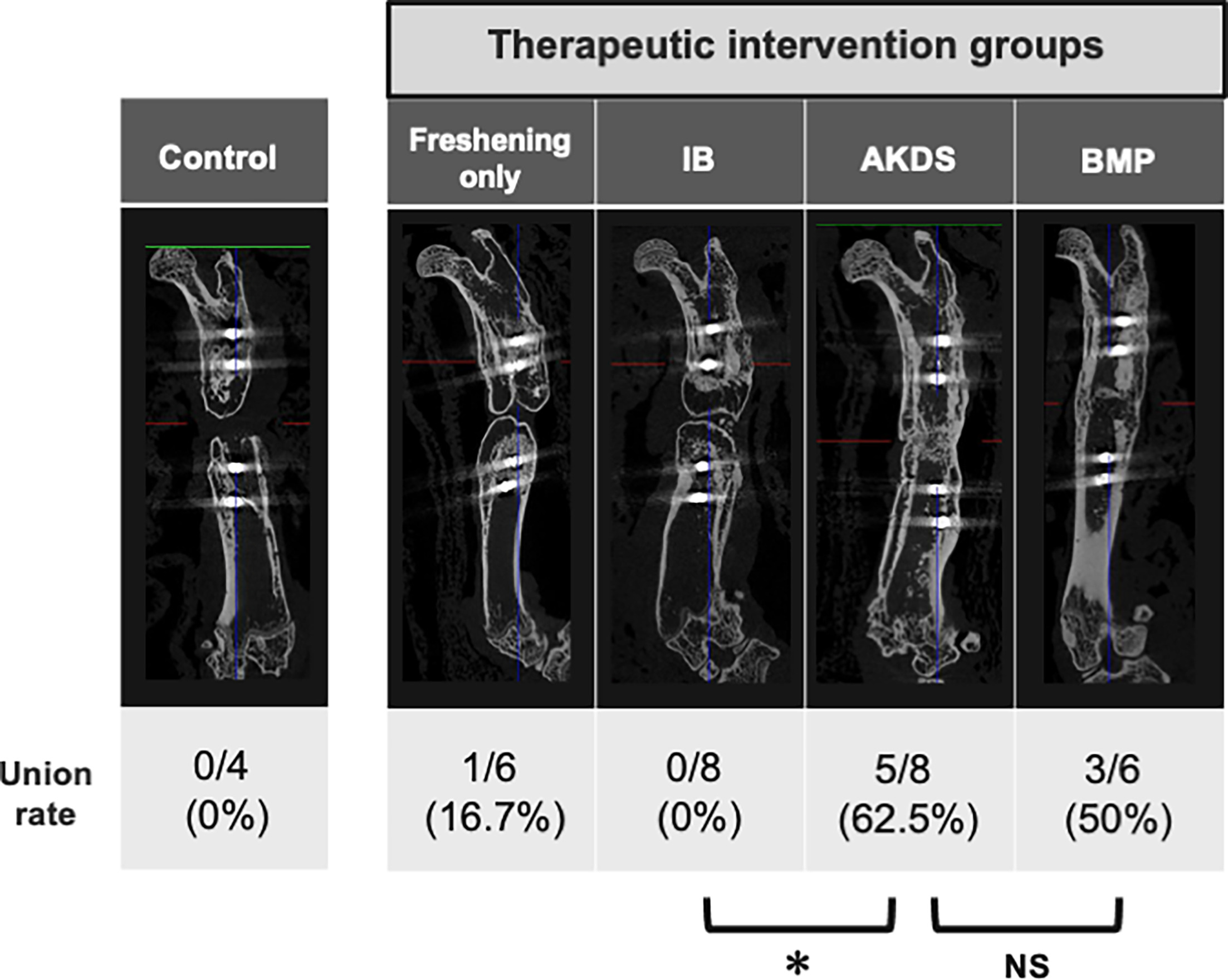 Fig. 4 
            Representative micro-CT images and union rates of control and four different intervention groups. The union rate of the AKDS group (n = 5/8, 62.5%) was significantly higher than that of the iliac bone (IB) group (n = 0/8, 0%), and was comparable to that of the bone morphogenetic protein (BMP) group (n = 3/6, 50%). *p = 0.026, all p-values calculated with Fisher’s exact test. ns, not significant.
          