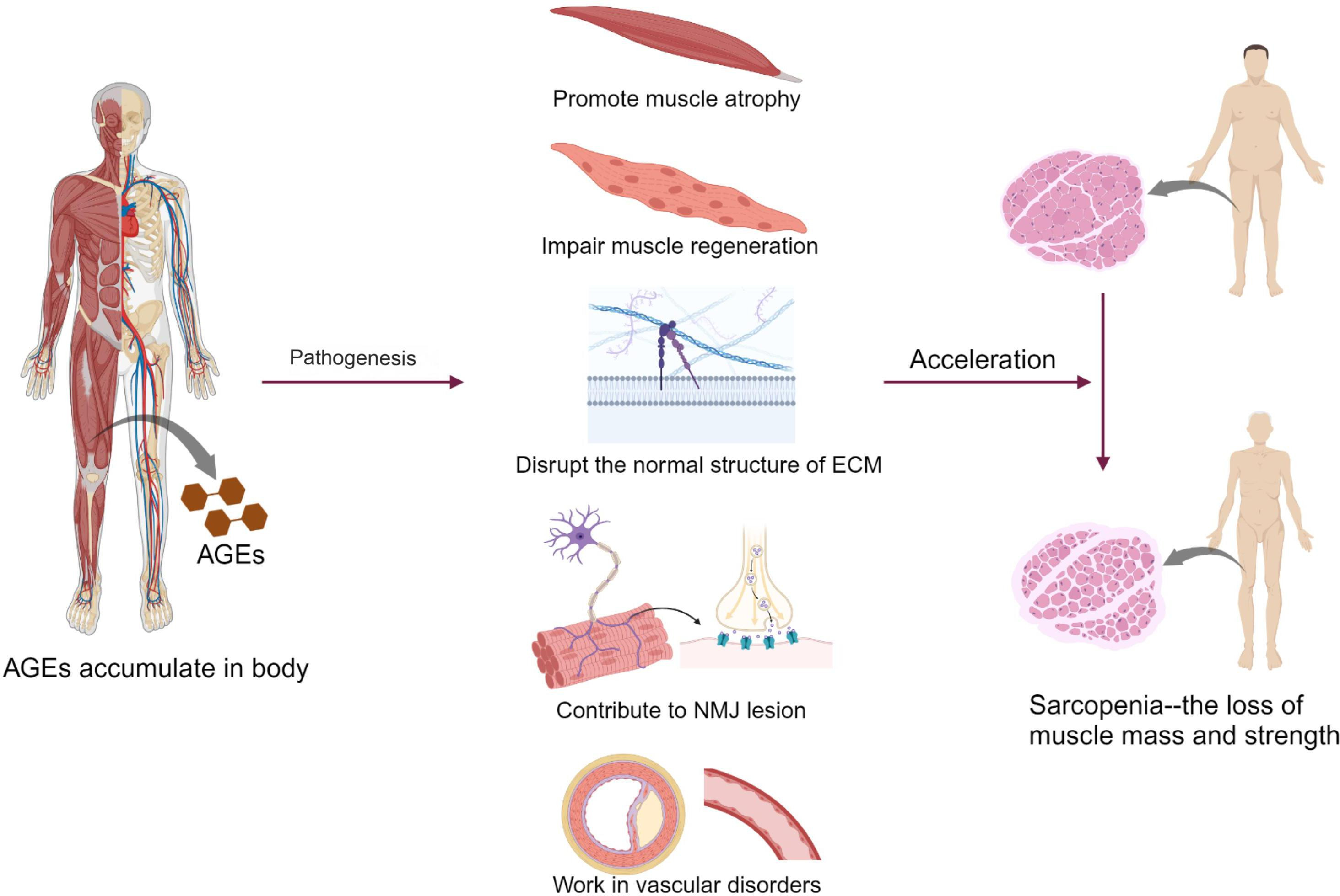 Fig. 3 
          The pathogenic role of advanced glycation end-products (AGEs) in skeletal muscle. ECM, extracellular matrix; NMJ, neuromuscular junction. Created with BioRender.com, with permission.
        