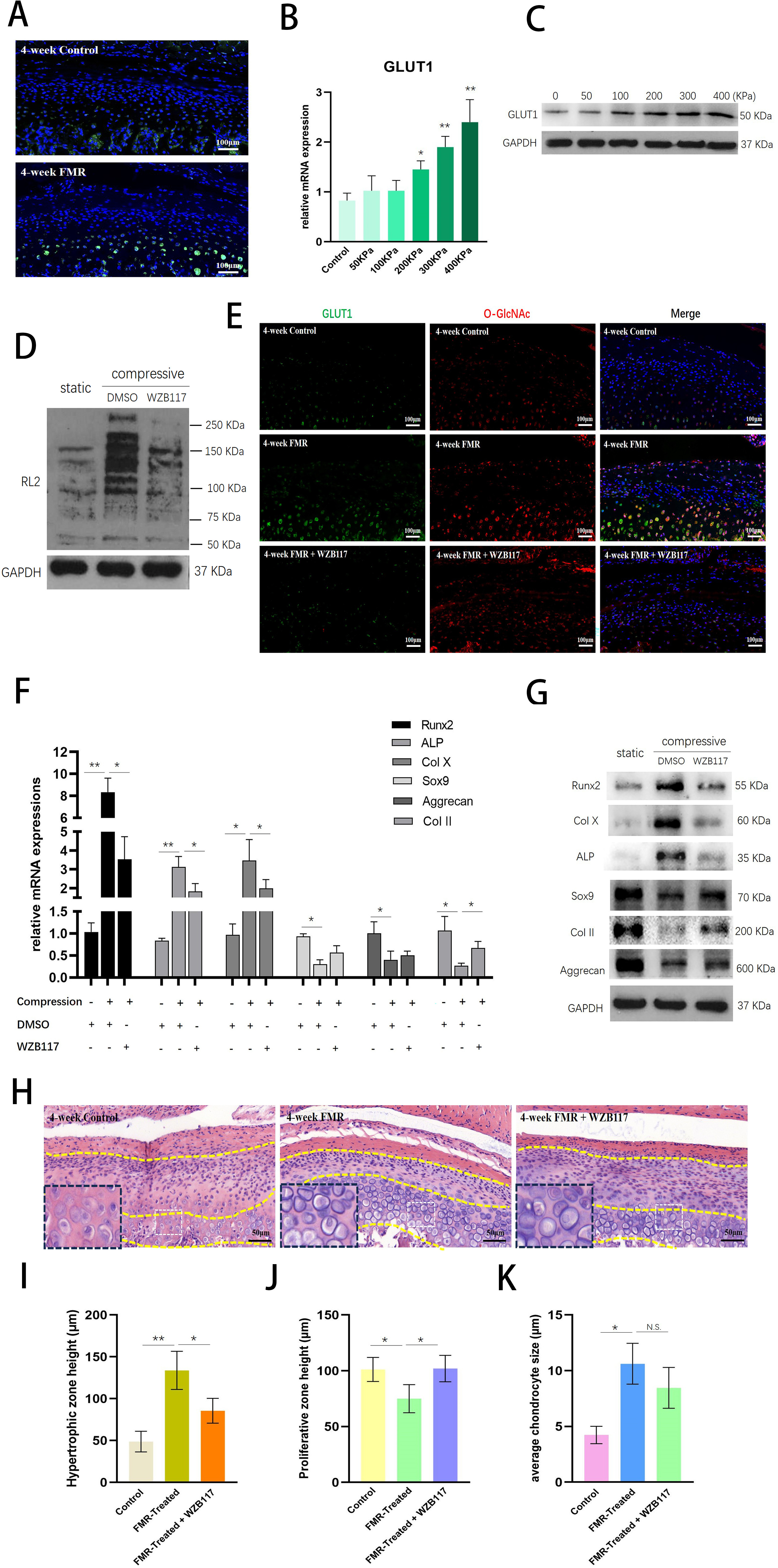 Fig. 5 
            Mechanical compression-induced chondrocyte hypertrophy partially relied on O-GlcNAcylation of Runx2. a) Quantitative real-time reverse transcription polymerase chain reaction (qRT-PCR) results of Runx2, Sox9, Col X, Col II, alkaline phosphatase (ALP), and aggrecan messenger RNA (mRNA) levels in chondrocytes after mechanical compression at different magnitudes. b) Western blot results of Runx2, Sox9, Col X, Col II, ALP, aggrecan, and O-GlcNAc protein levels in chondrocytes after mechanical compression at different magnitudes. c) RL2 and Sox9 or Runx2 double immunofluorescence staining of chondrocytes after mechanical compression at 400 kPa. Scale bar: 50 μm. d) Co-immunoprecipitation and immunoblotting of Runx2 or Sox9 with RL2 antibody, in chondrocytes after mechanical compression at 400 kPa. e) Western blot results of Runx2, Sox9, and O-GlcNAc protein levels in chondrocytes after mechanical compression at 400 kPa, with the addition of dimethyl sulfoxide (DMSO), Thiamet G, or OSMI-1. f) Luciferase reporter gene assay of Runx2 and Sox9 activities in chondrocytes after mechanical compression at 400 kPa, with addition of DMSO, Thiamet G, or OSMI-1. g) qRT-PCR results of Col X, Col II, ALP, and aggrecan mRNA levels in chondrocytes transfected with Runx2 short hairpin RNA (shRNA) or scrambled shRNA, with the addition of DMSO, Thiamet G, or OSMI-1. h) Western blots results of Col X, Col II, ALP, and aggrecan protein levels in chondrocytes transfected with Runx2 shRNA or scrambled shRNA, with addition of DMSO, Thiamet G, or OSMI-1. *p < 0.05, **p < 0.01. N. S., not significant. GAPDH, glyceraldehyde-3-phosphate dehydrogenase.
          