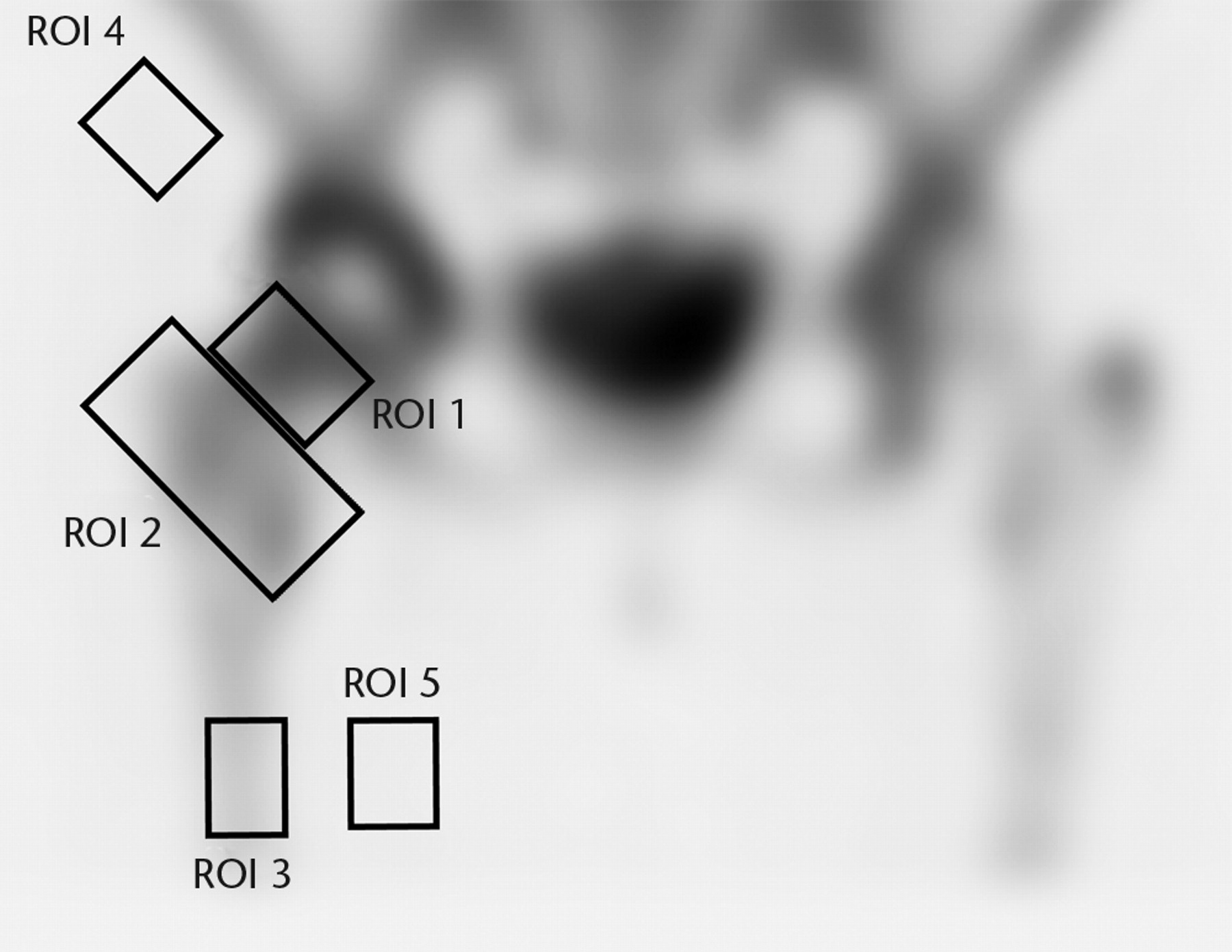 Fig. 2 
            A single photon emission computed tomography
(SPECT-CT) image showing the five regions of interest (ROIs).
          